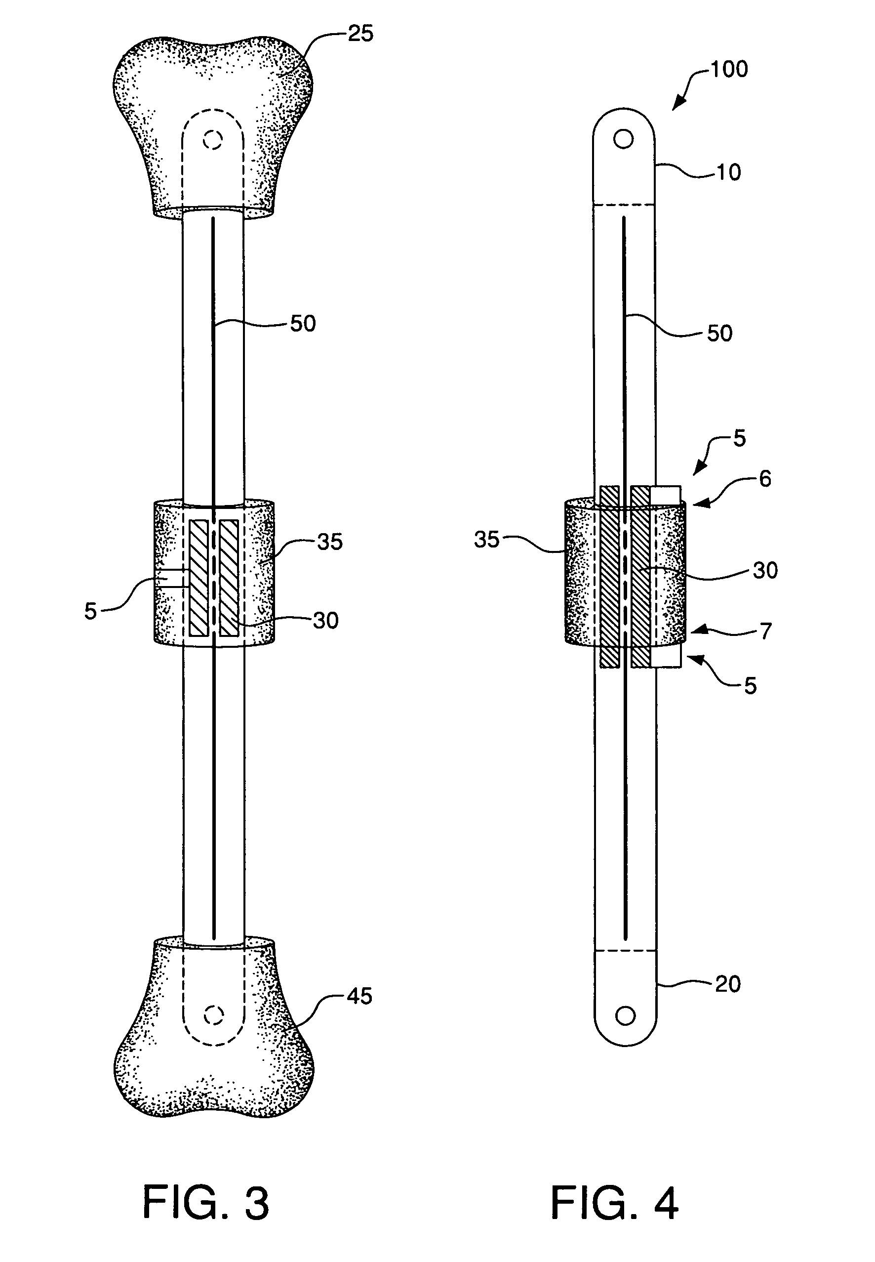 Internal bone transport