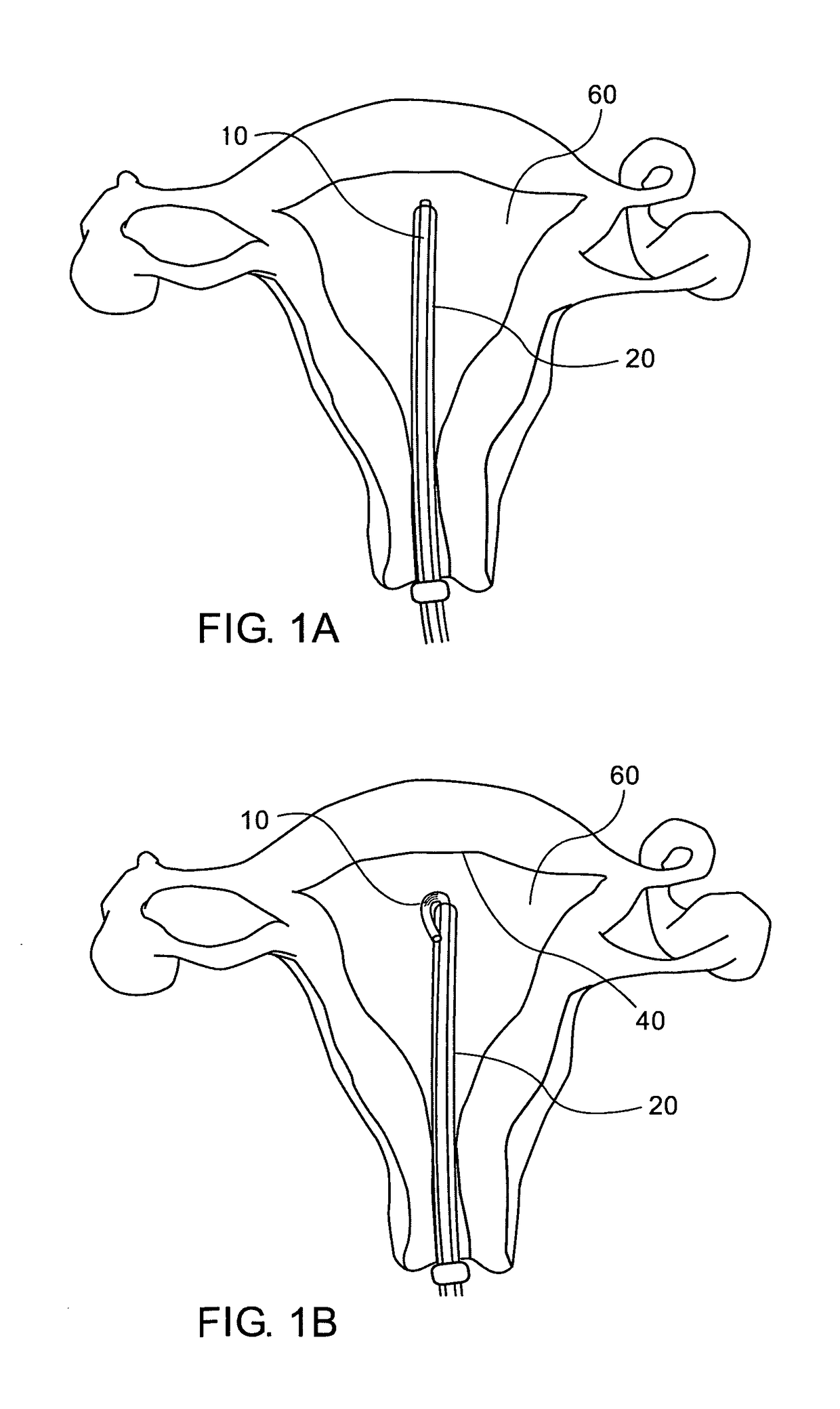 Intra uterine device