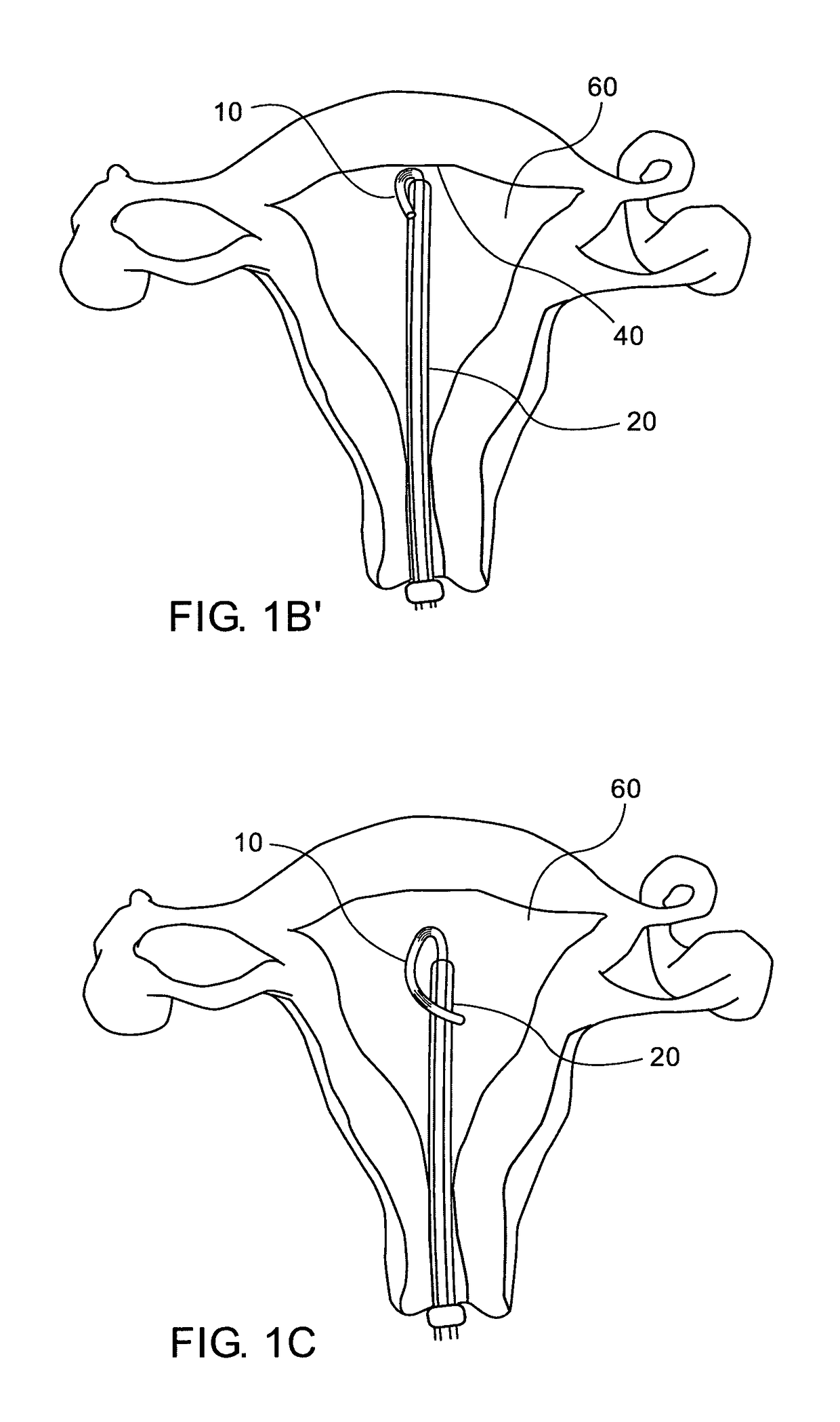 Intra uterine device