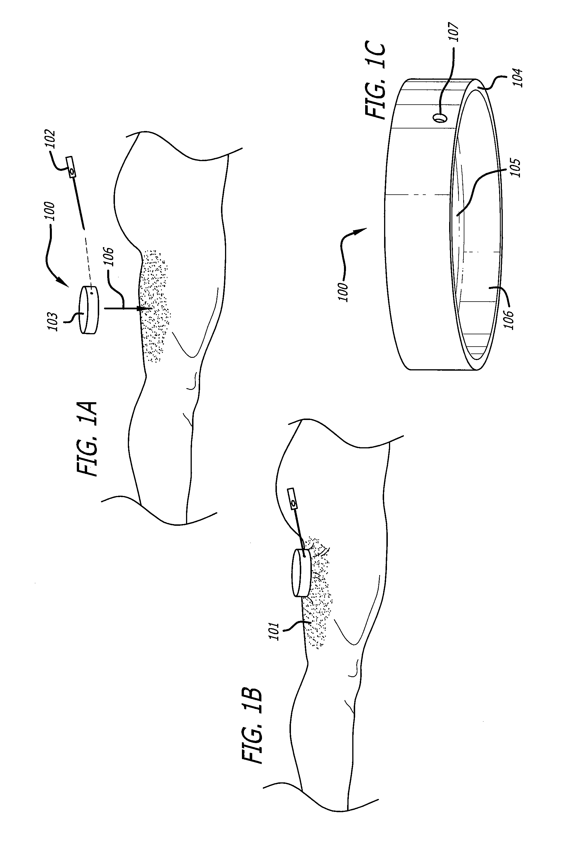 Dissection handpiece with aspiration means for reducing the appearance of cellulite