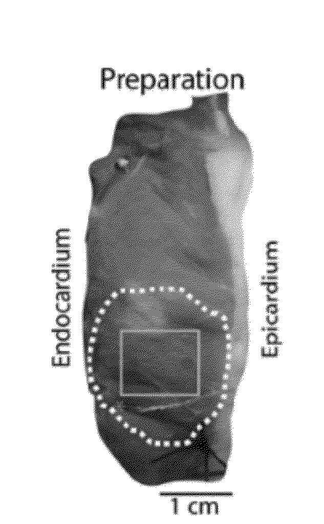 Method for Ameliorating or Preventing Arrhythmic Risk Associated with Cardiomyopathy by Improving Conduction Velocity