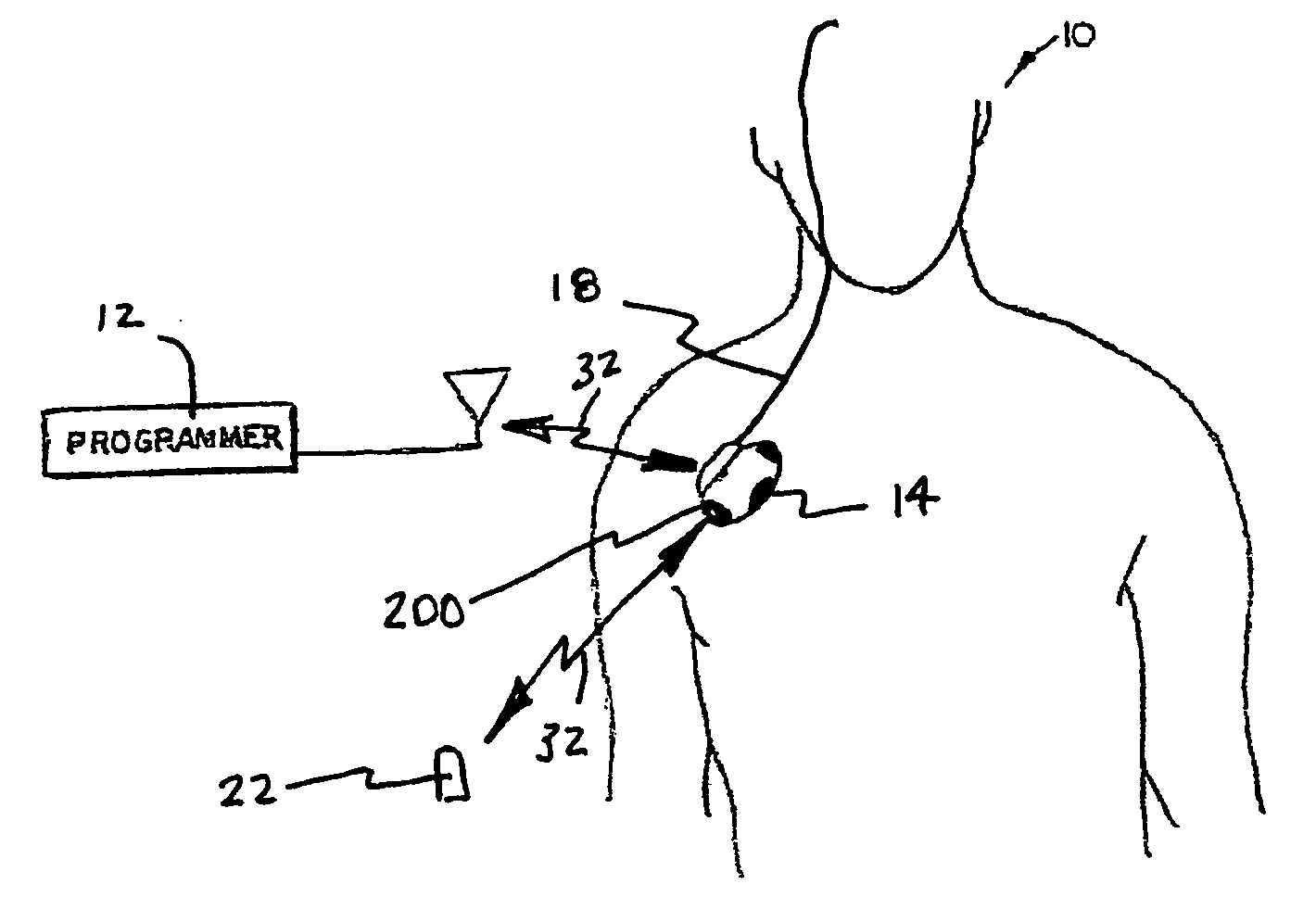 System and method for regulating cardiac triggered therapy to the brain