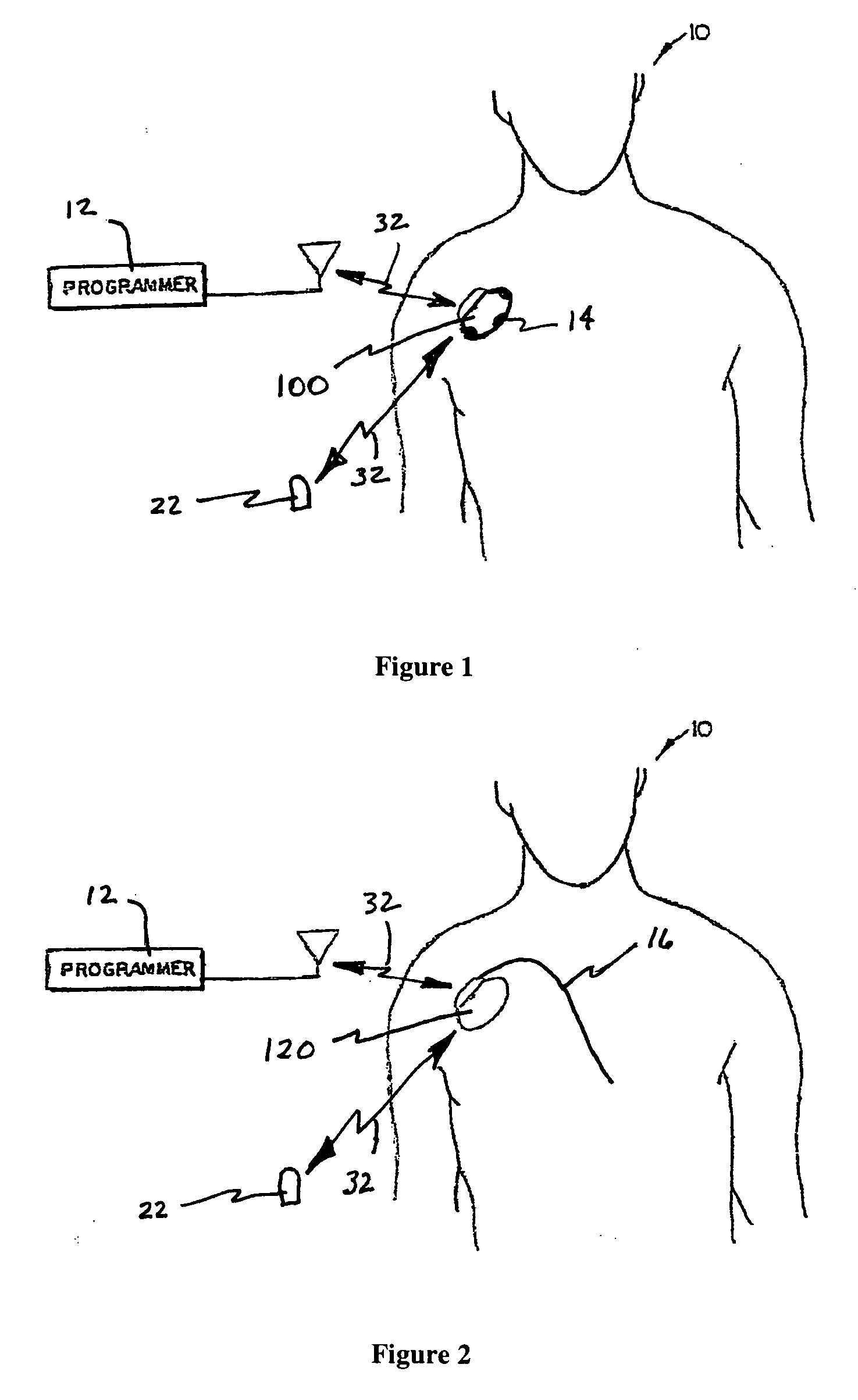 System and method for regulating cardiac triggered therapy to the brain