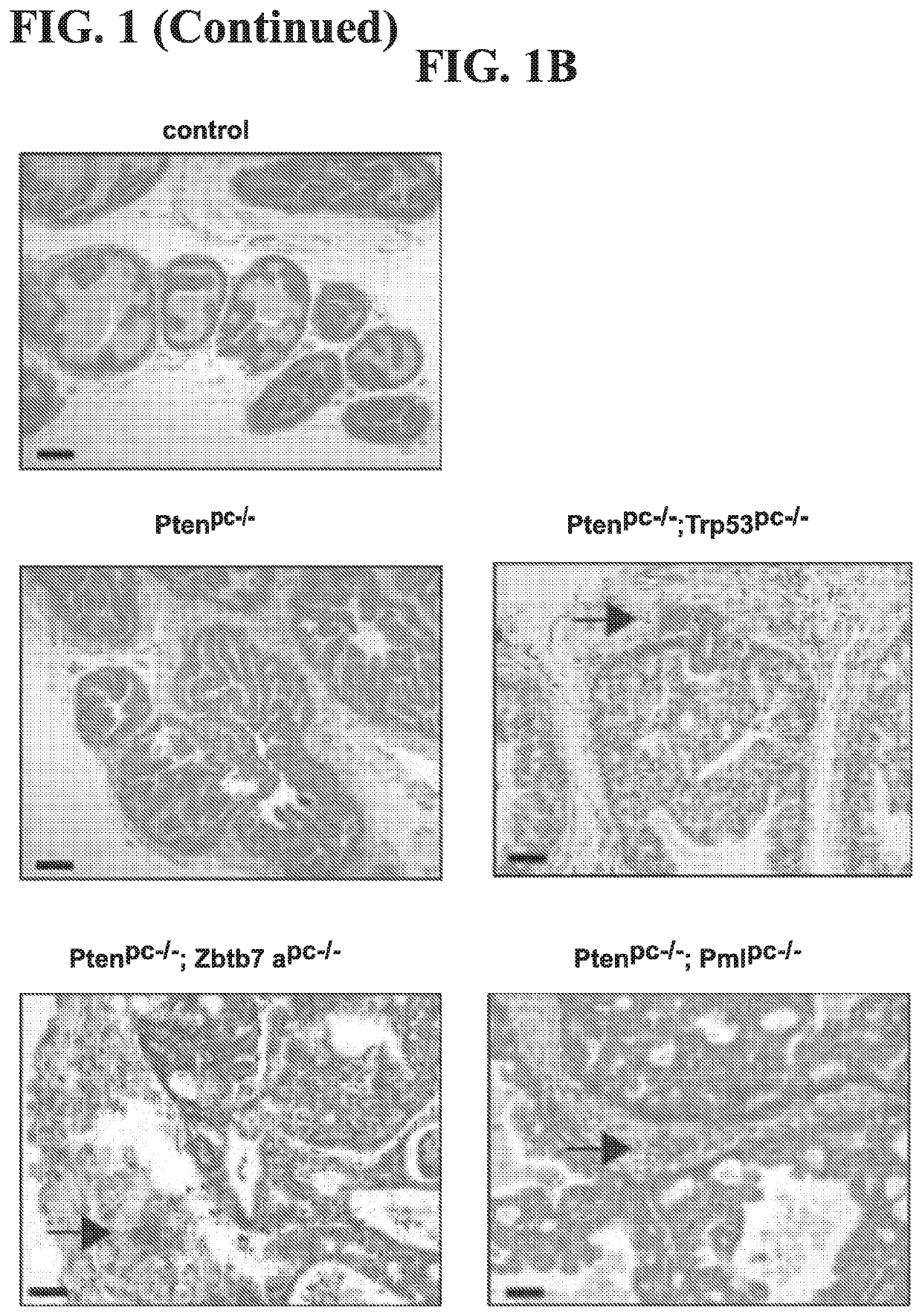 Compositions and methods for treating a tumor suppressor deficient cancer