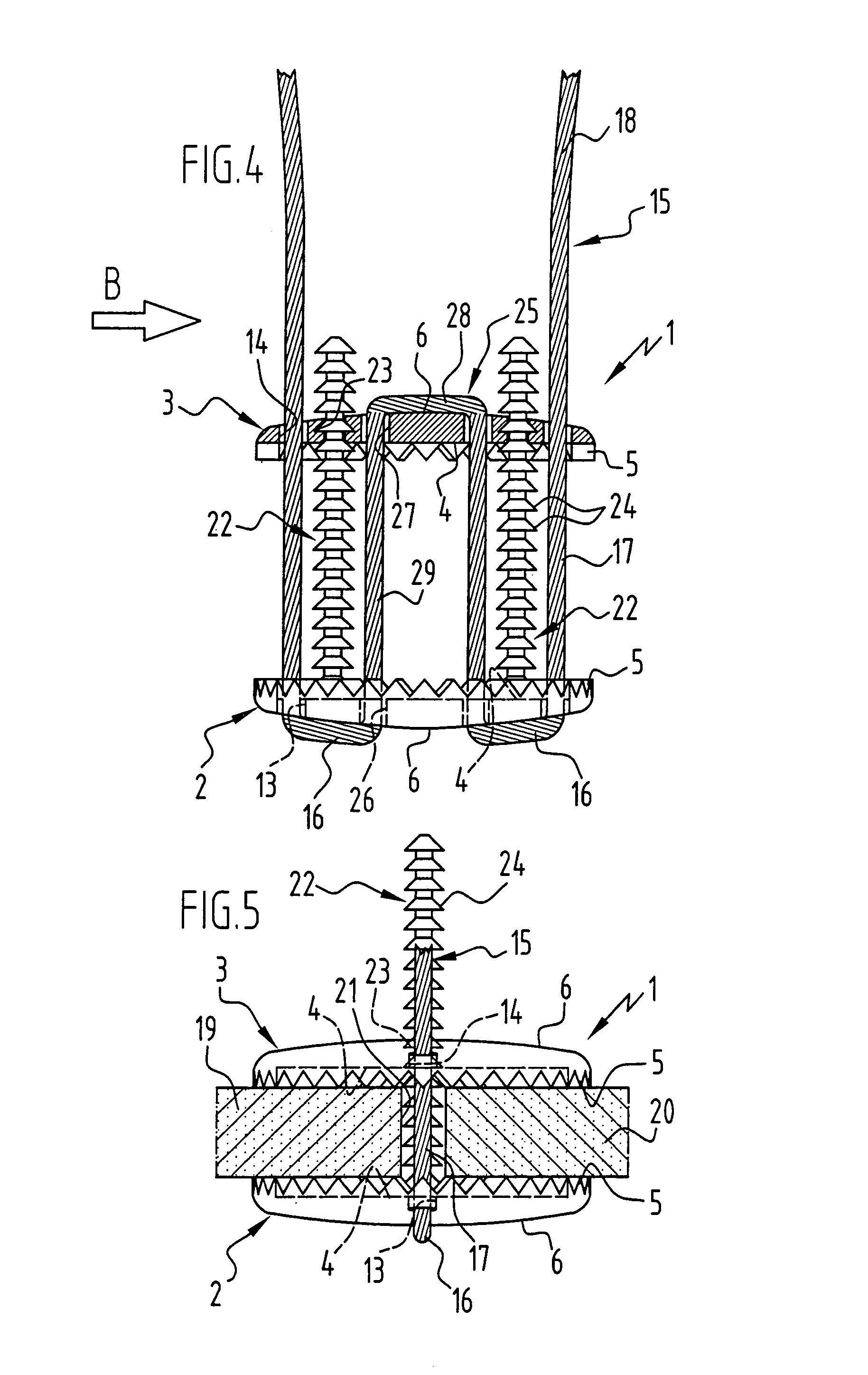 Implant for fixing bone plates