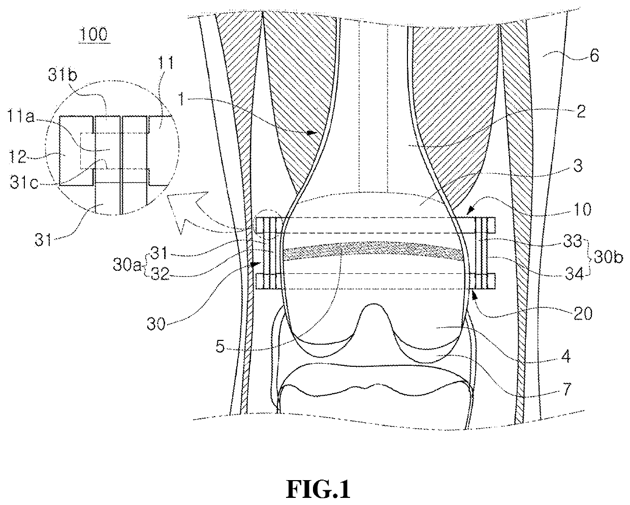 Implant device for promoting bone growth