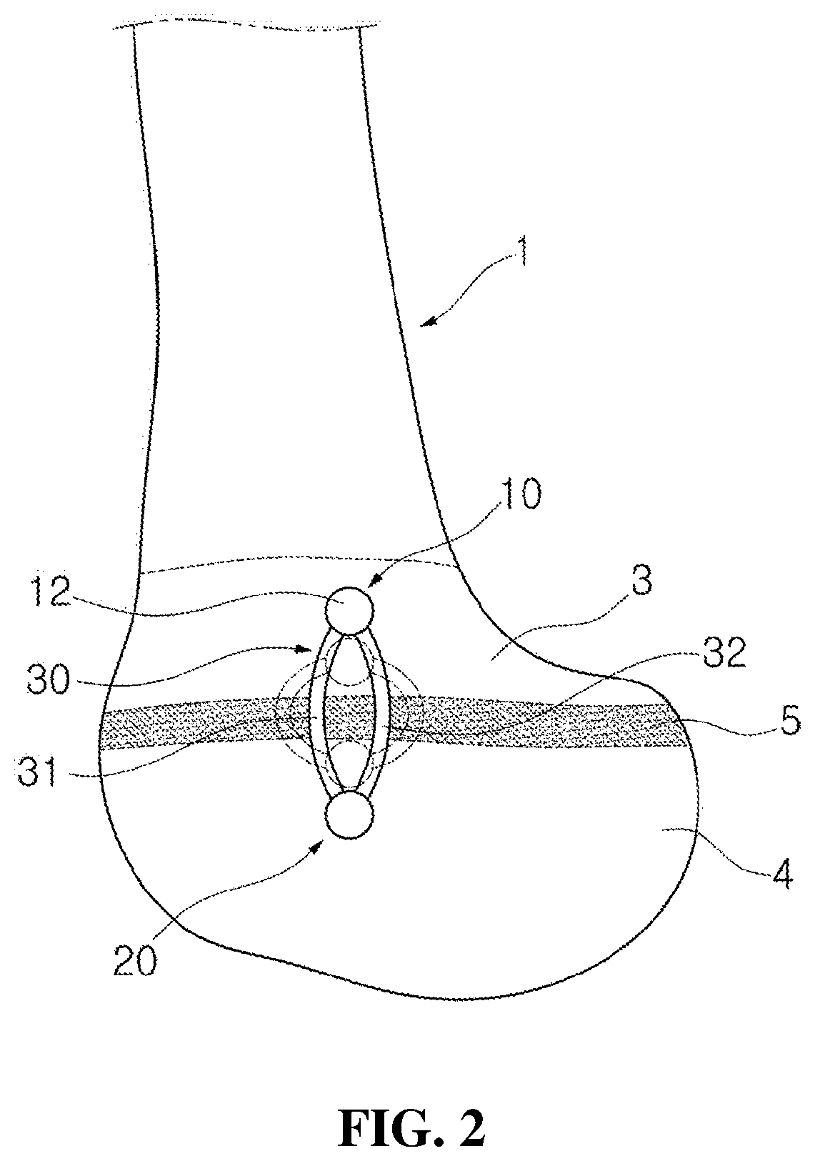 Implant device for promoting bone growth