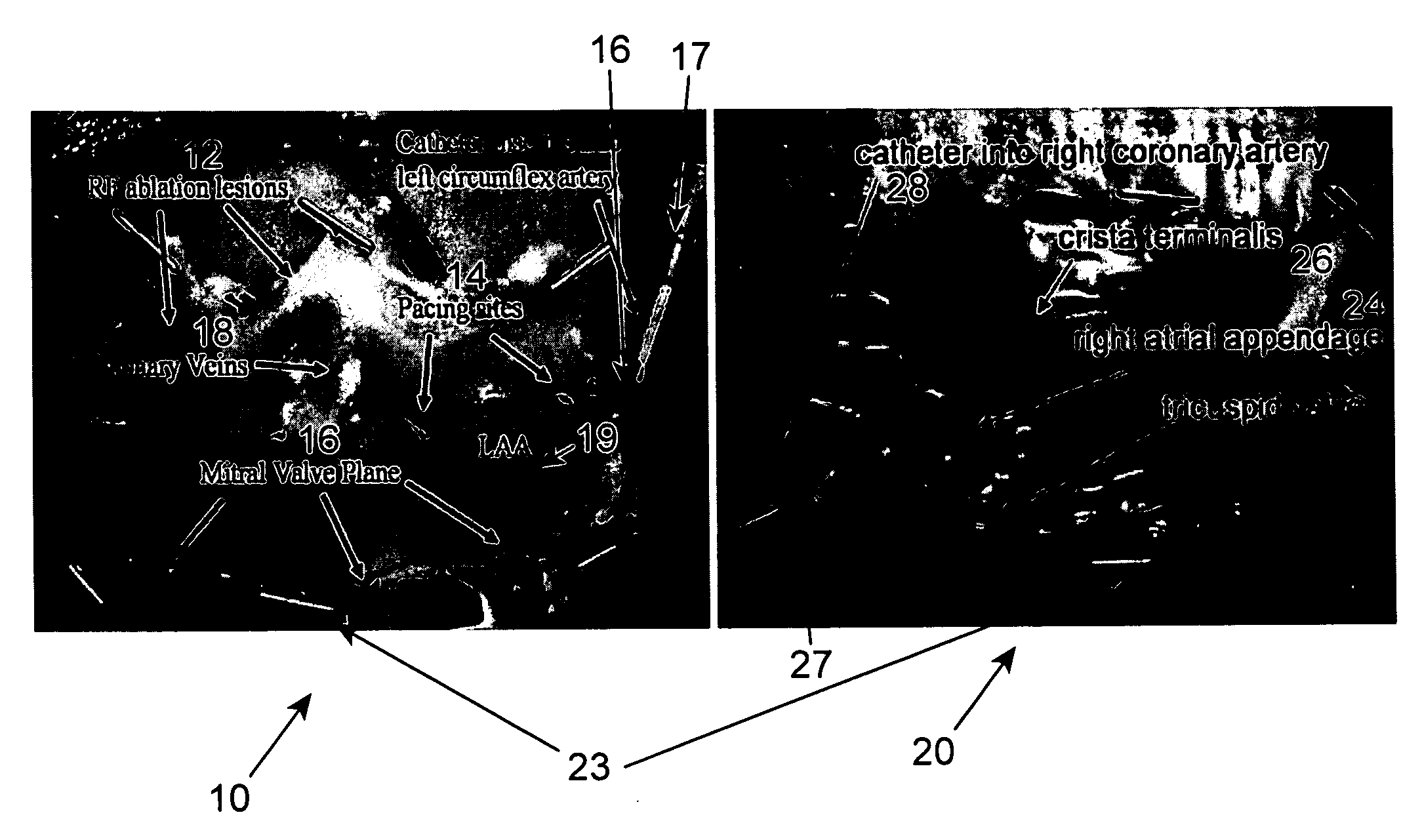 Method and associated system for the interventional treatment of atrial fibrillation