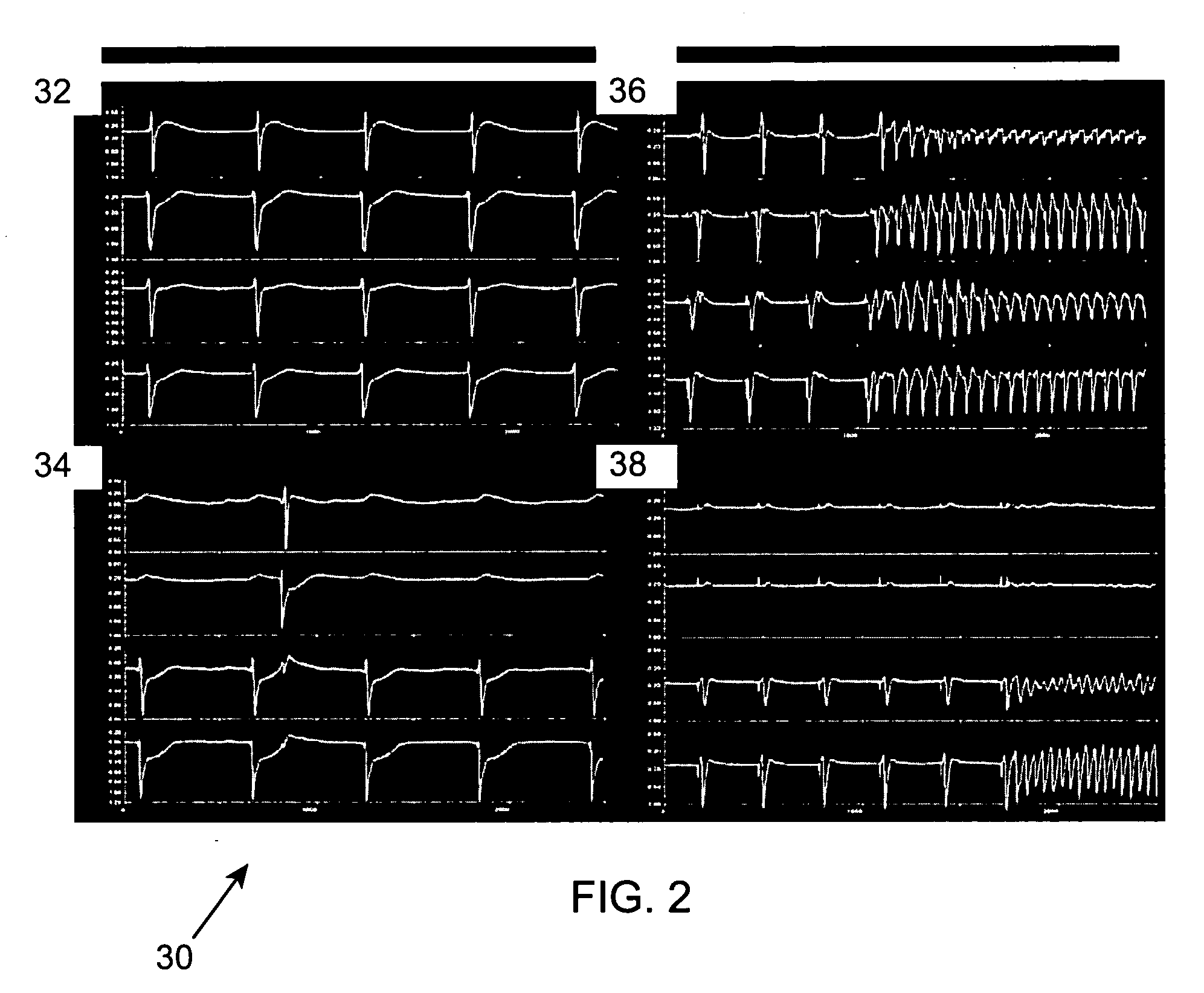 Method and associated system for the interventional treatment of atrial fibrillation