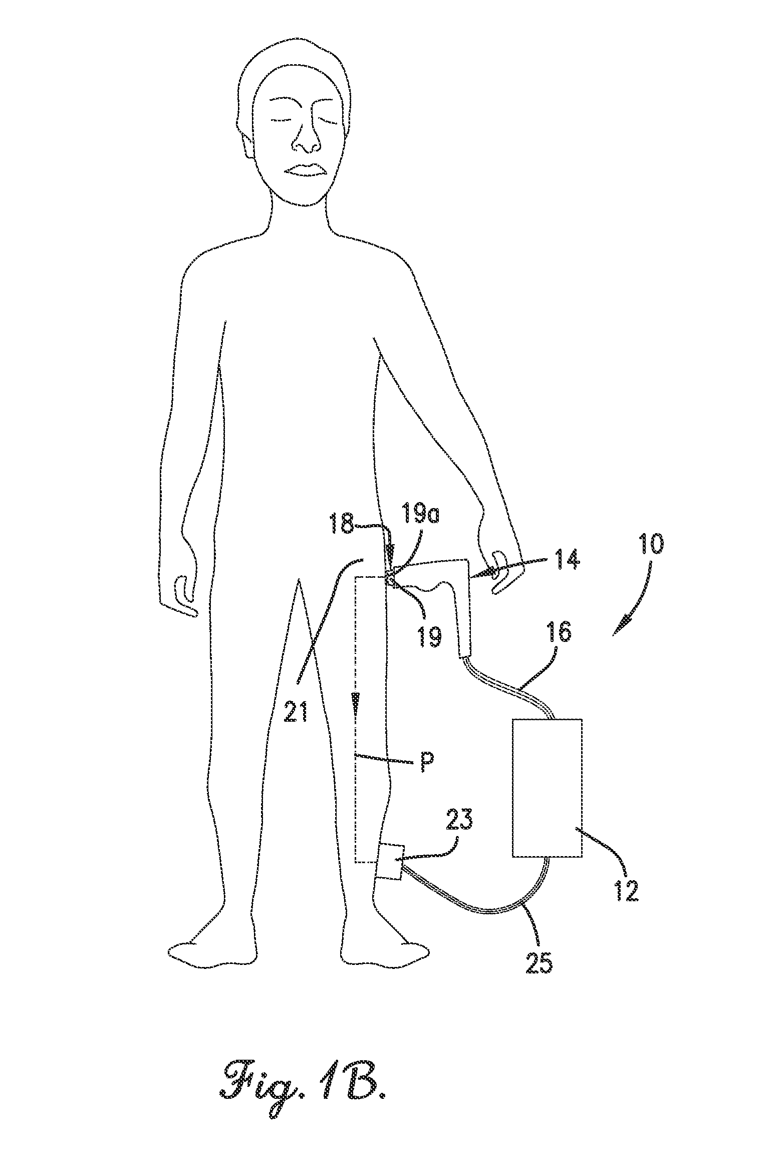 Electrode assembly and handpiece with adjustable system impedance, and methods of operating an energy-based medical system to treat tissue