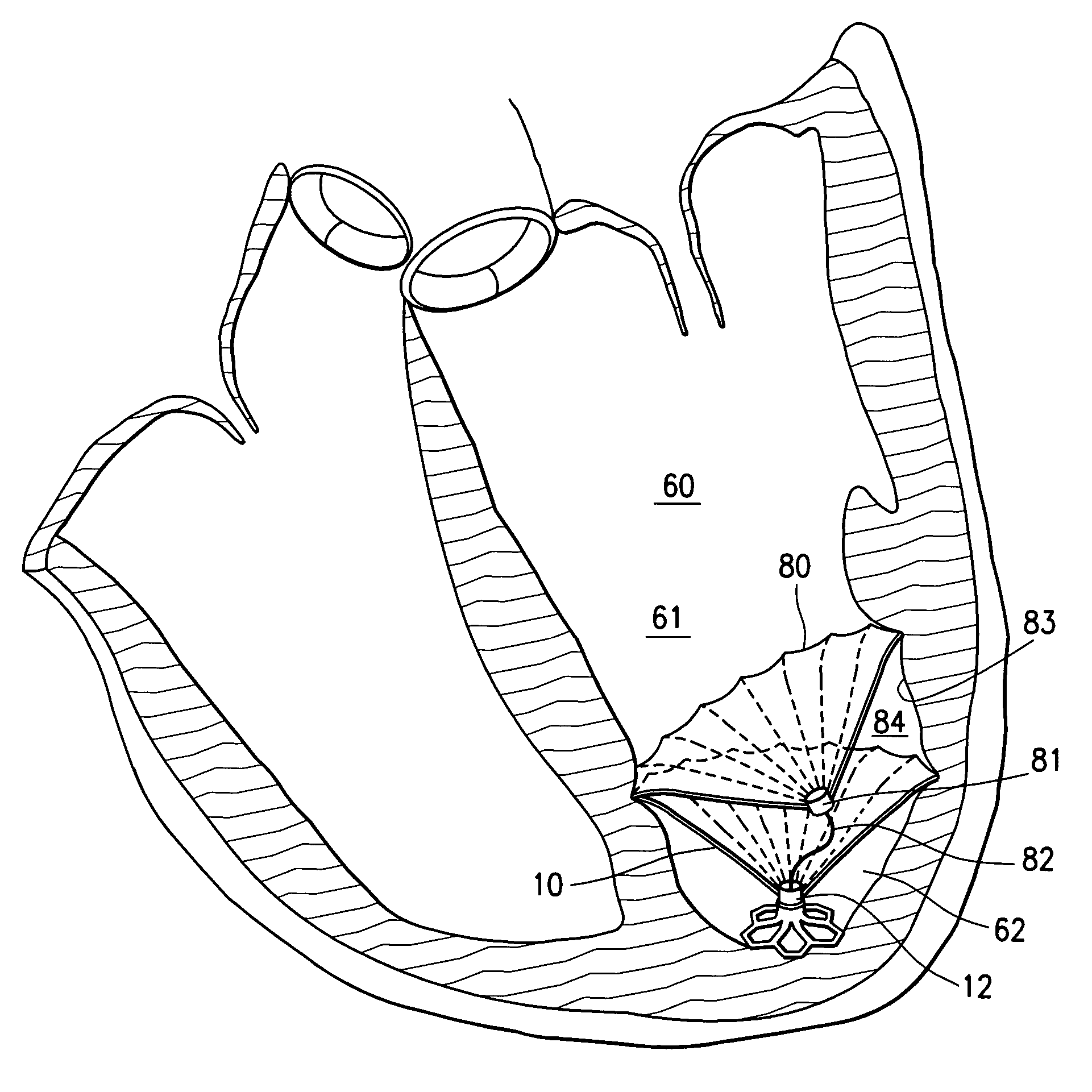 Multiple partitioning devices for heart treatment