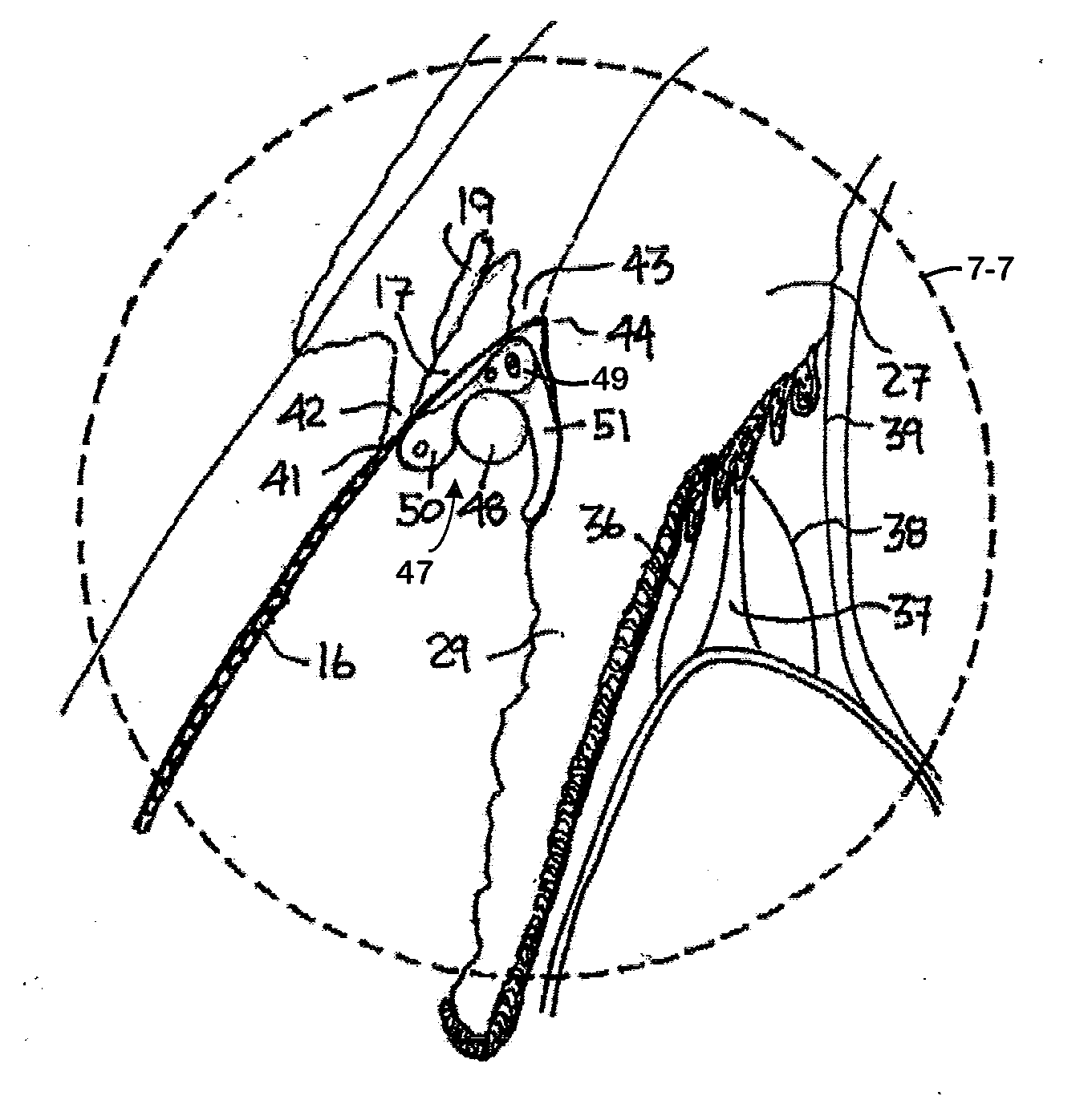 Ocular Collar Stent for Treating Narrowing of the Irideocorneal Angle