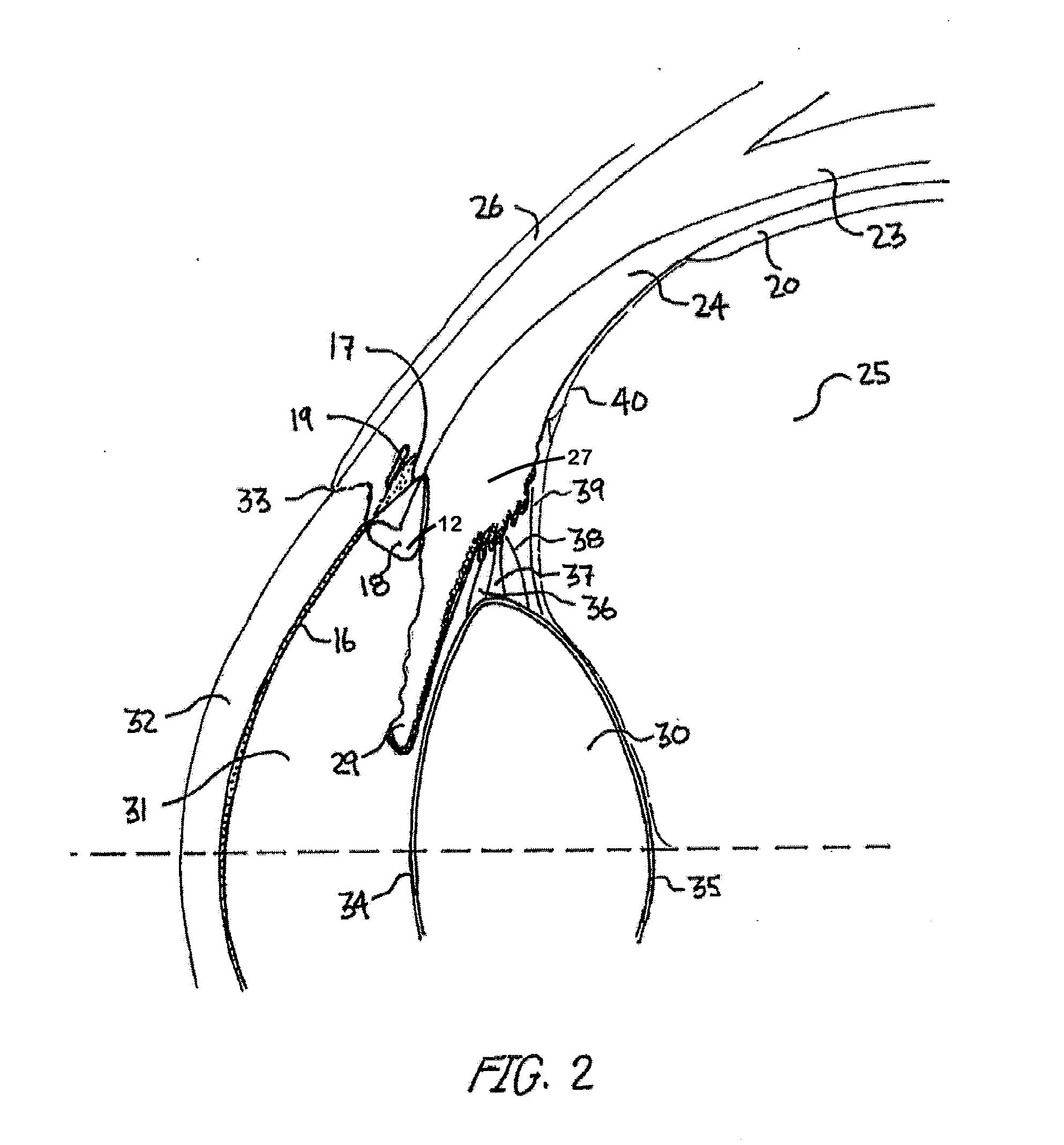 Ocular Collar Stent for Treating Narrowing of the Irideocorneal Angle