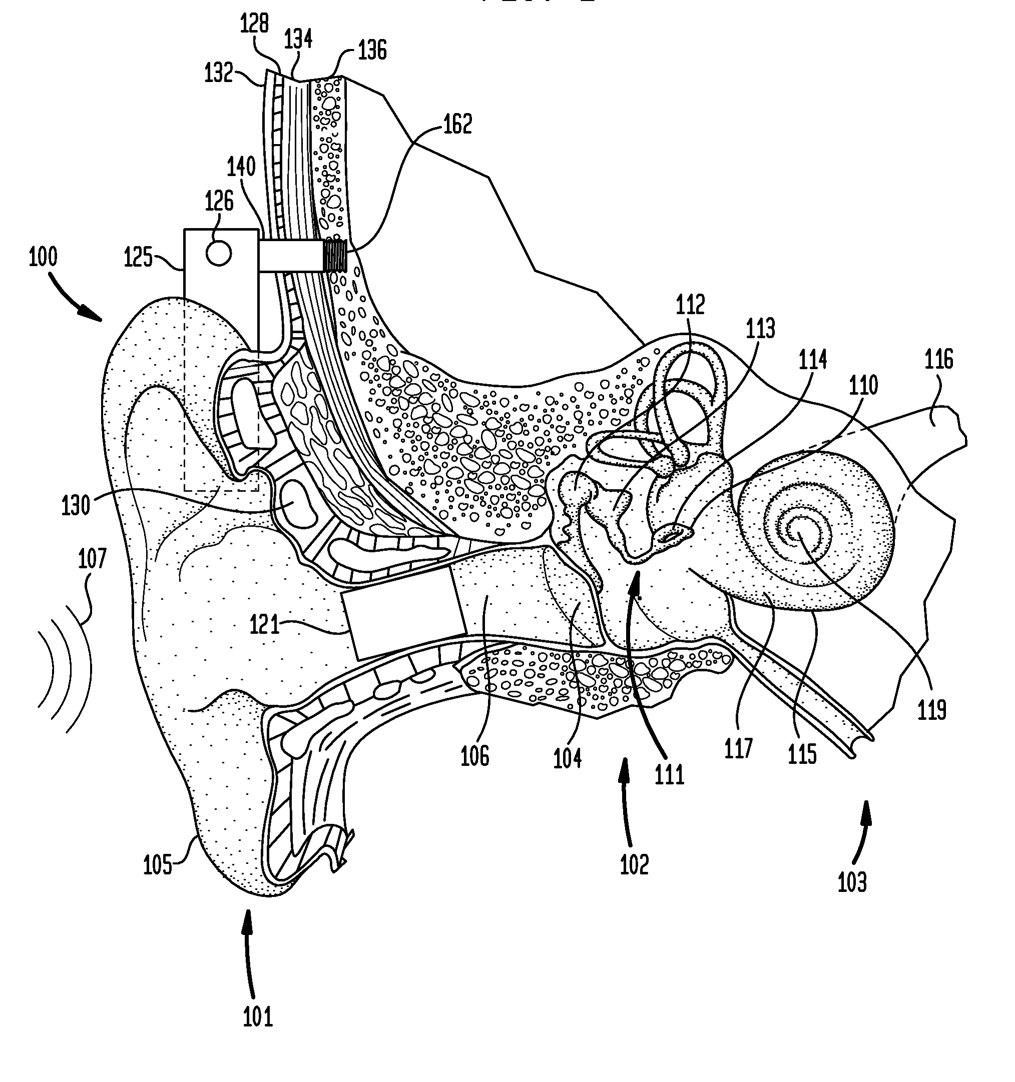 Multi-mode hearing prosthesis