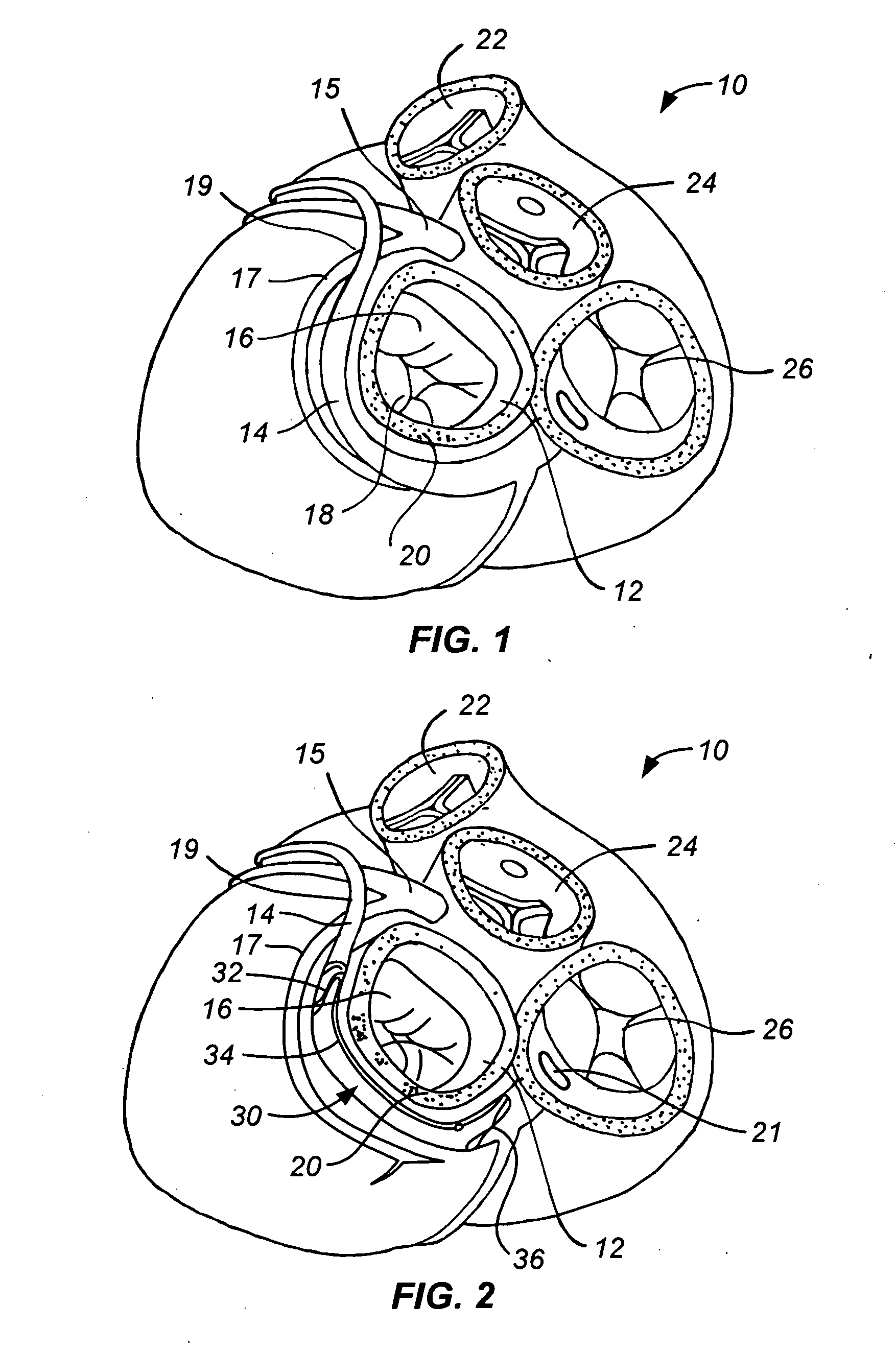 Fixed length anchor and pull mitral valve device and method