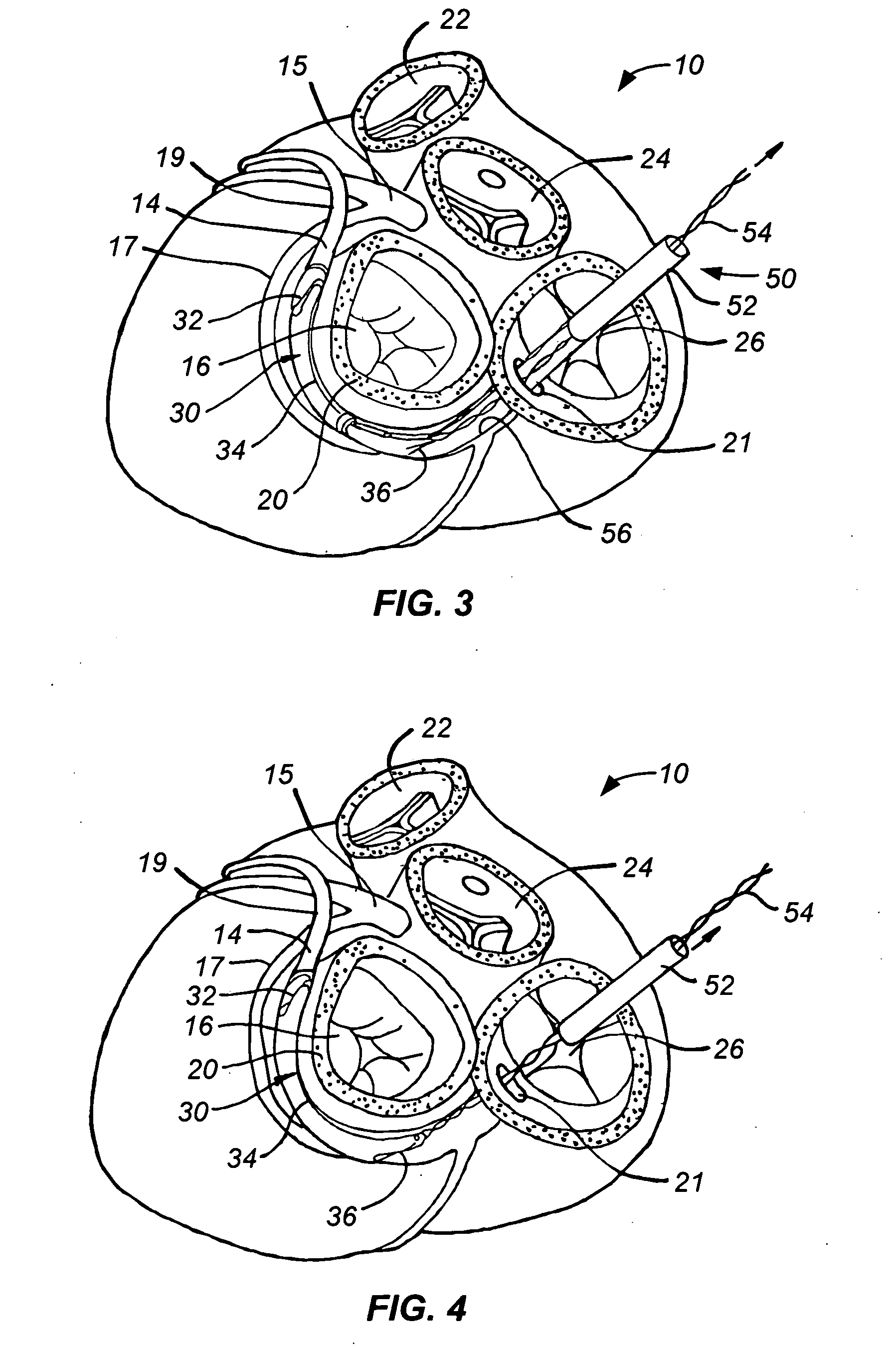 Fixed length anchor and pull mitral valve device and method