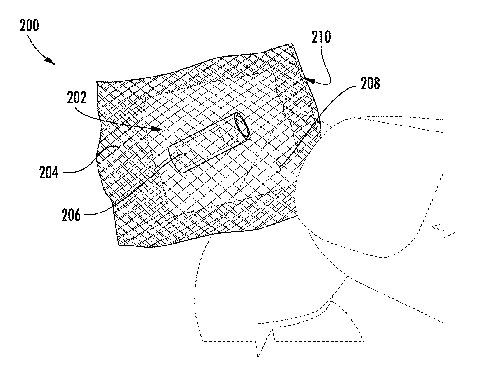 Wirelessly detectable objects for use in medical procedures and methods of making same