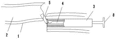 Intramedullary repositor for fracture of long bones of arms and legs