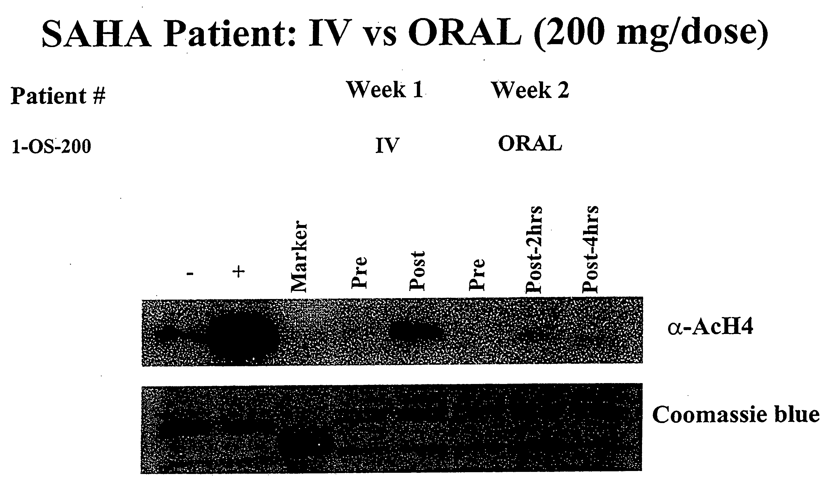 Methods of treating cancer with HDAC inhibitors