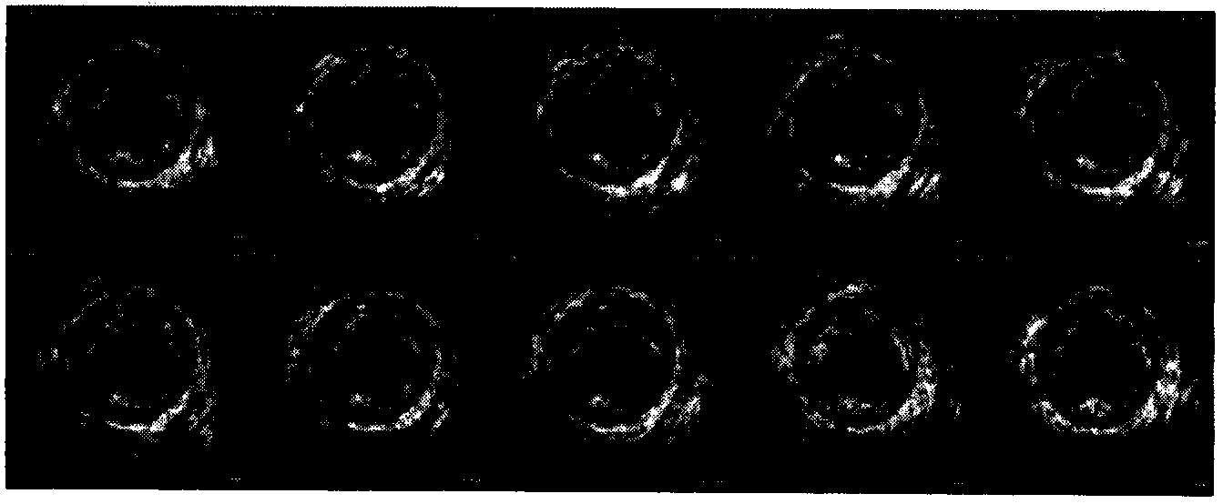 Automatic vessel wall edge detection method based on intravascular ultrasound image sequence