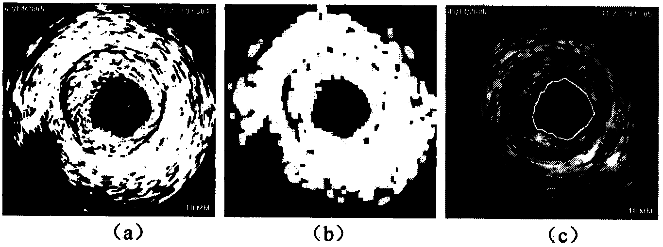 Automatic vessel wall edge detection method based on intravascular ultrasound image sequence