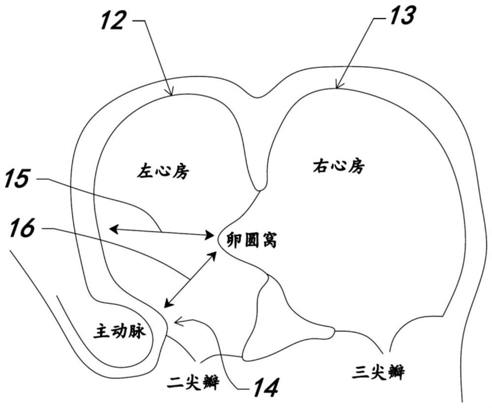 Puncture assembly suitable for atrial septum