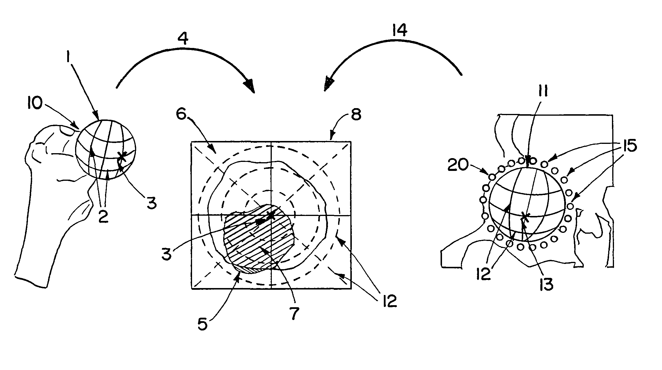 Computer-assisted joint analysis using surface projection