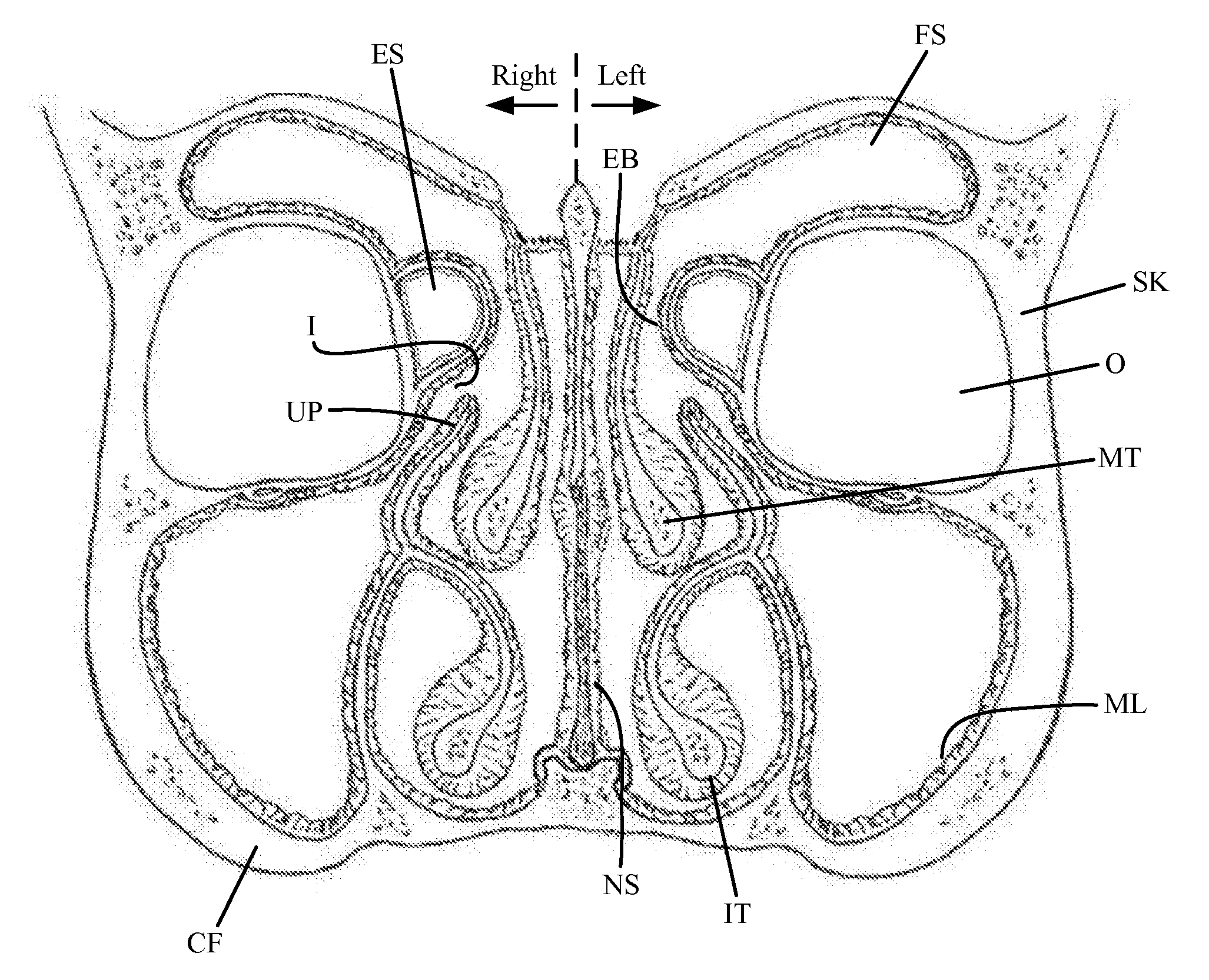 Method and device for remodeling the uncinate process