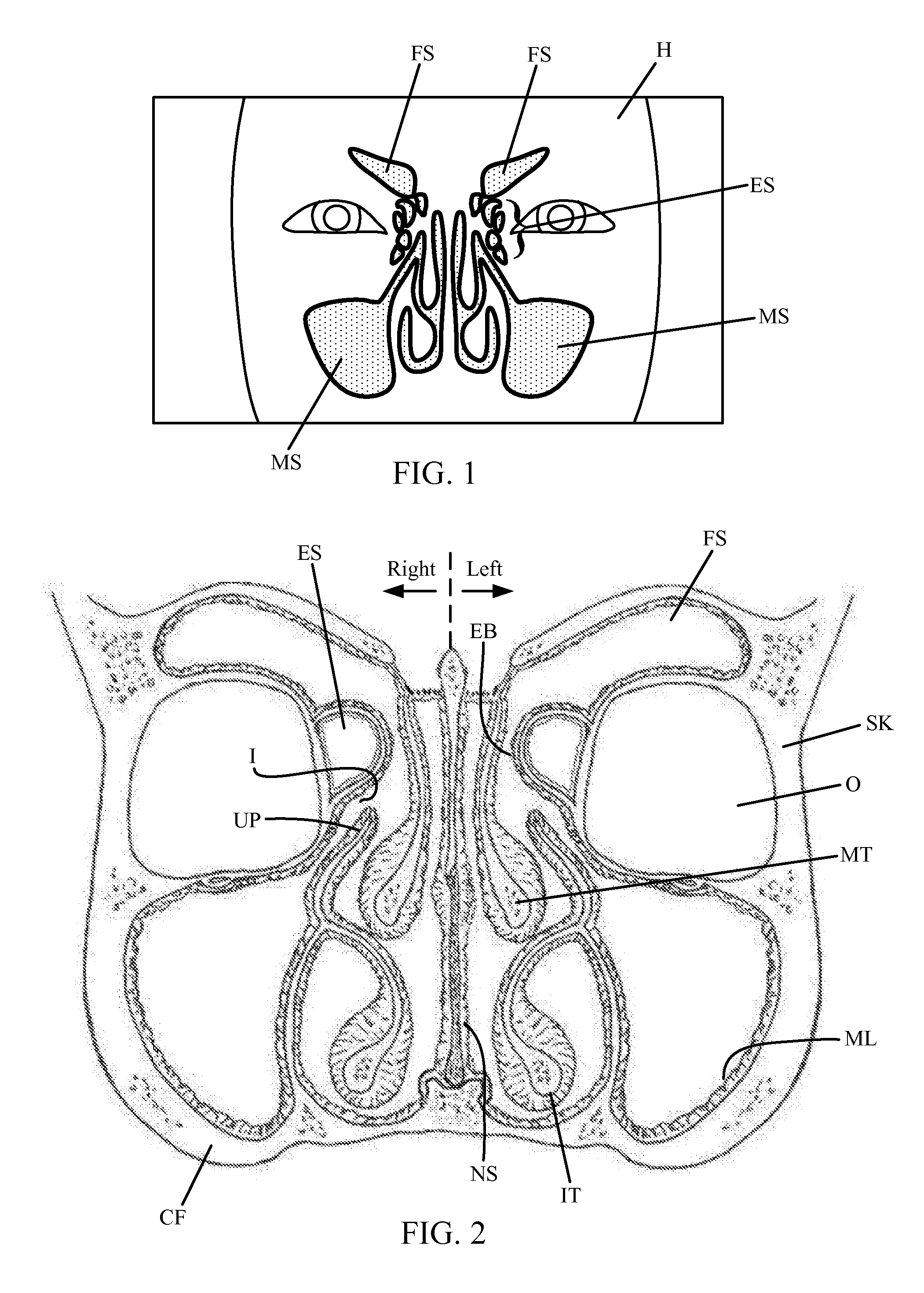 Method and device for remodeling the uncinate process