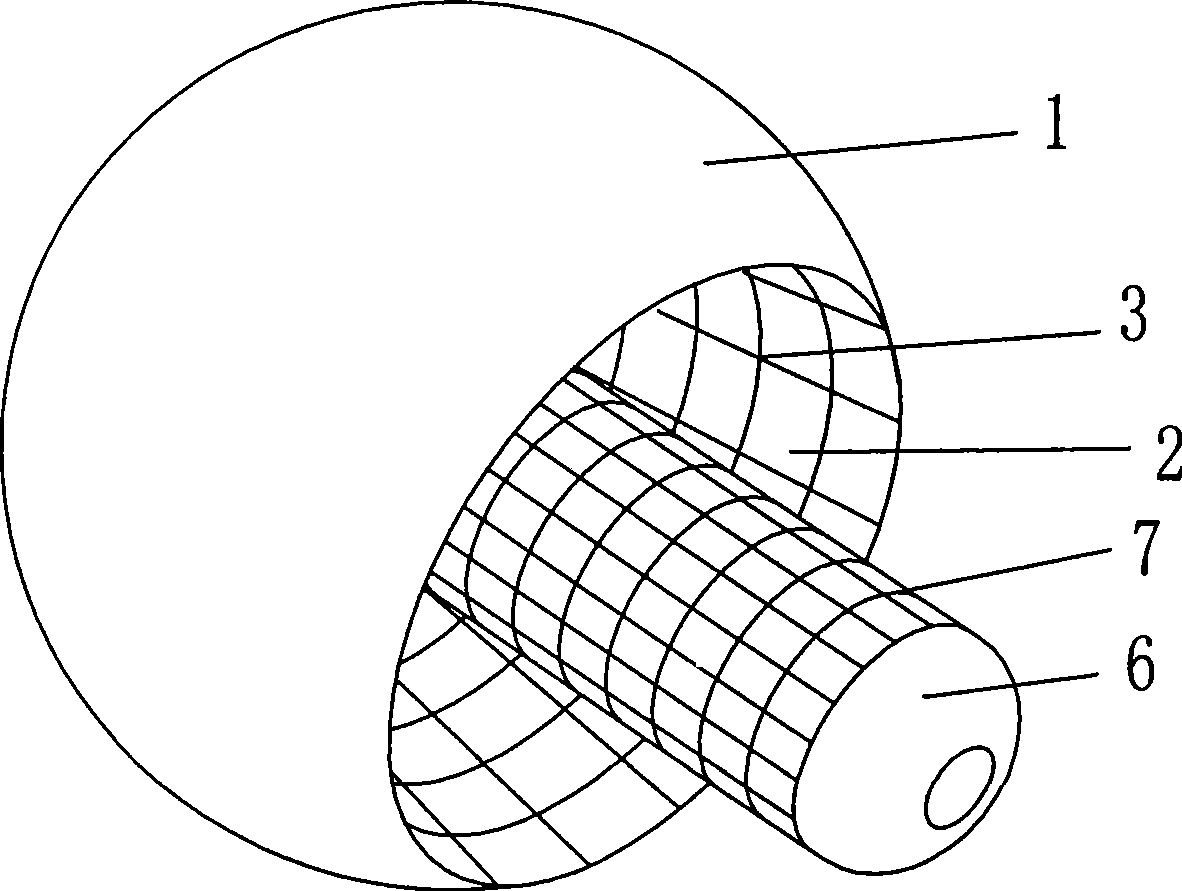 Artificial femoral head nested in femoral neck