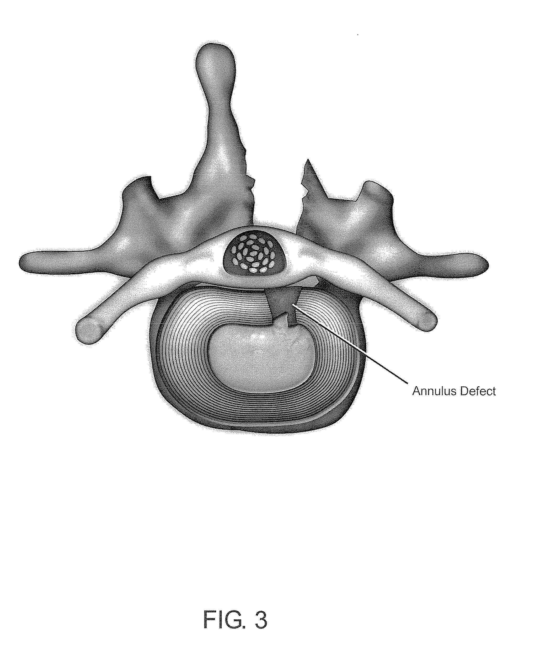 Methods and compositions for repair of cartilage using an in vivo bioreactor