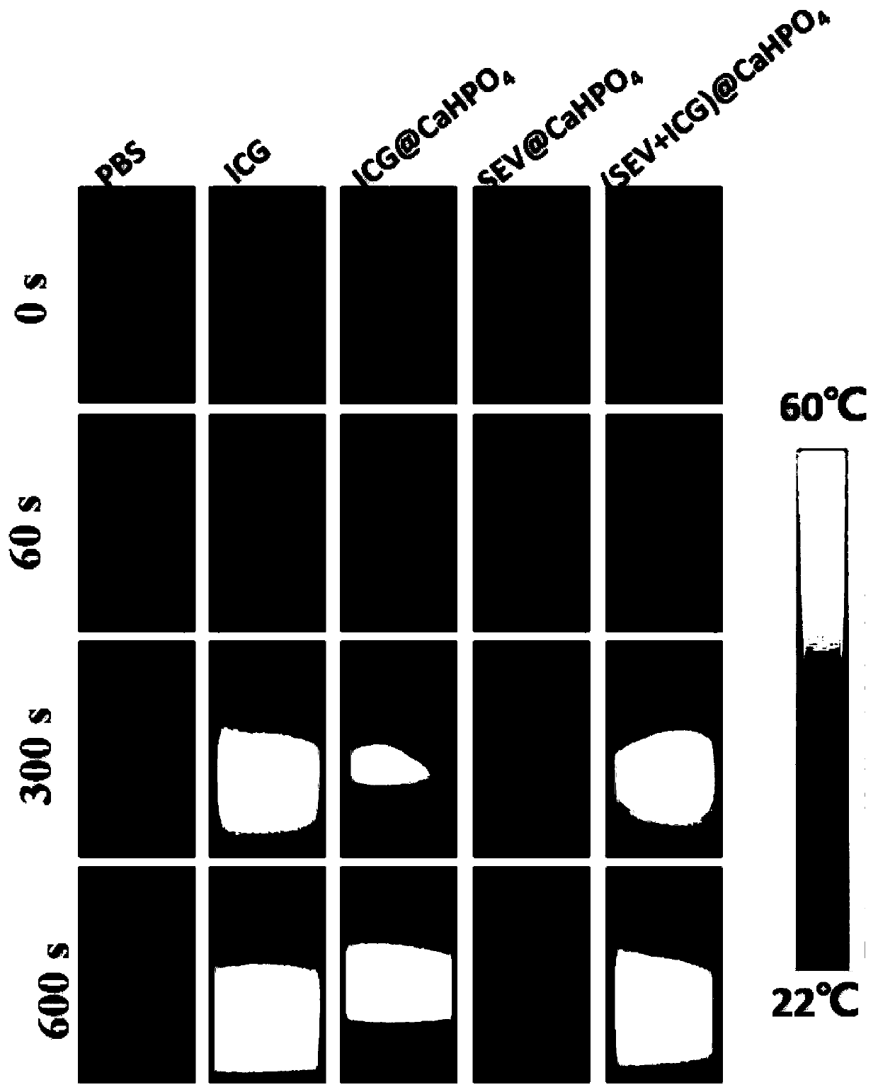 Synthetic method of mineralized sendai virus-based tumor combined treatment nano preparation