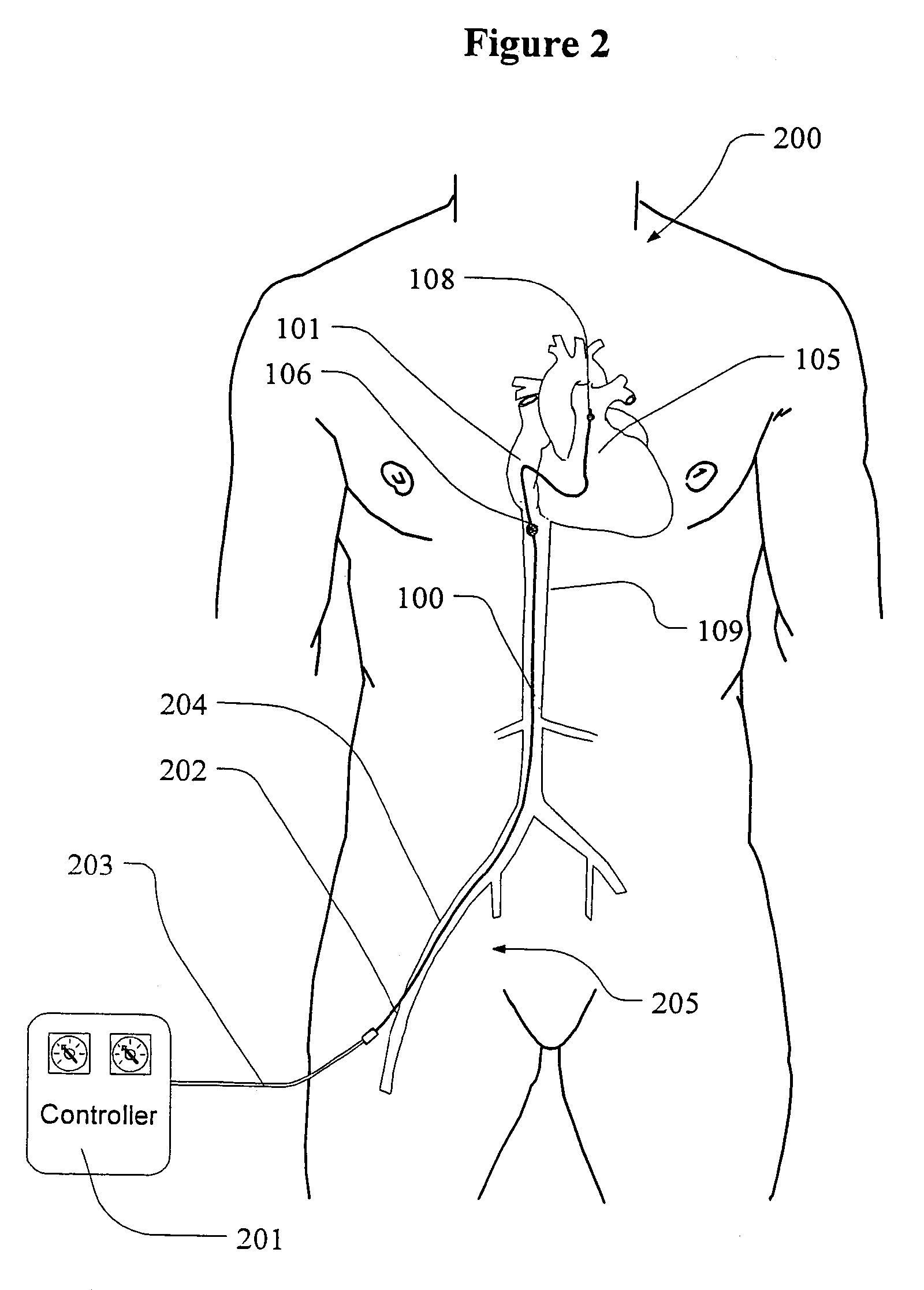 Treatment of infarct expansion by partially occluding vena cava