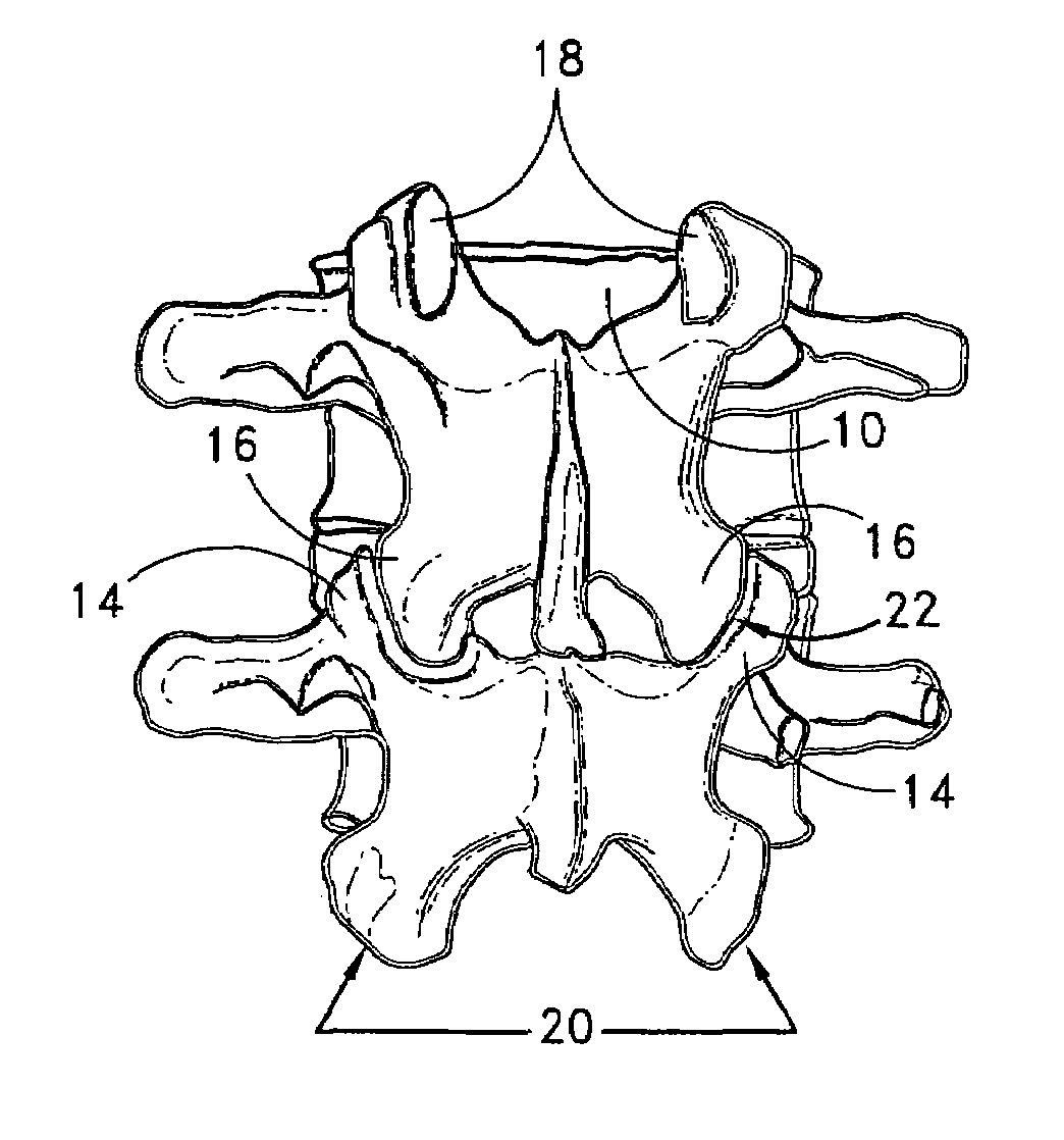 Method of spinal fixation using adhesive media