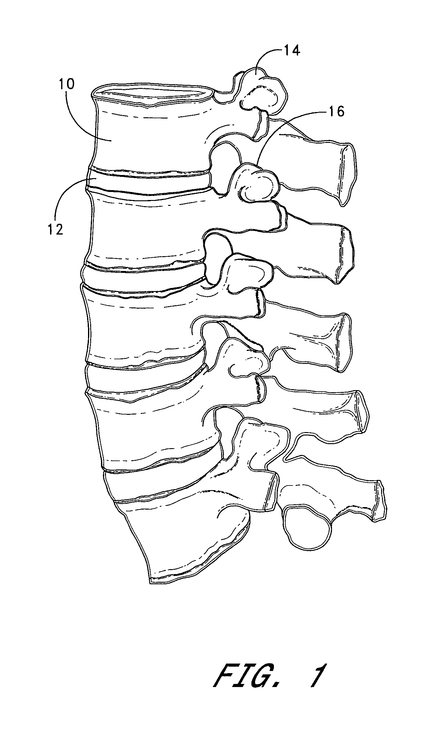 Method of spinal fixation using adhesive media