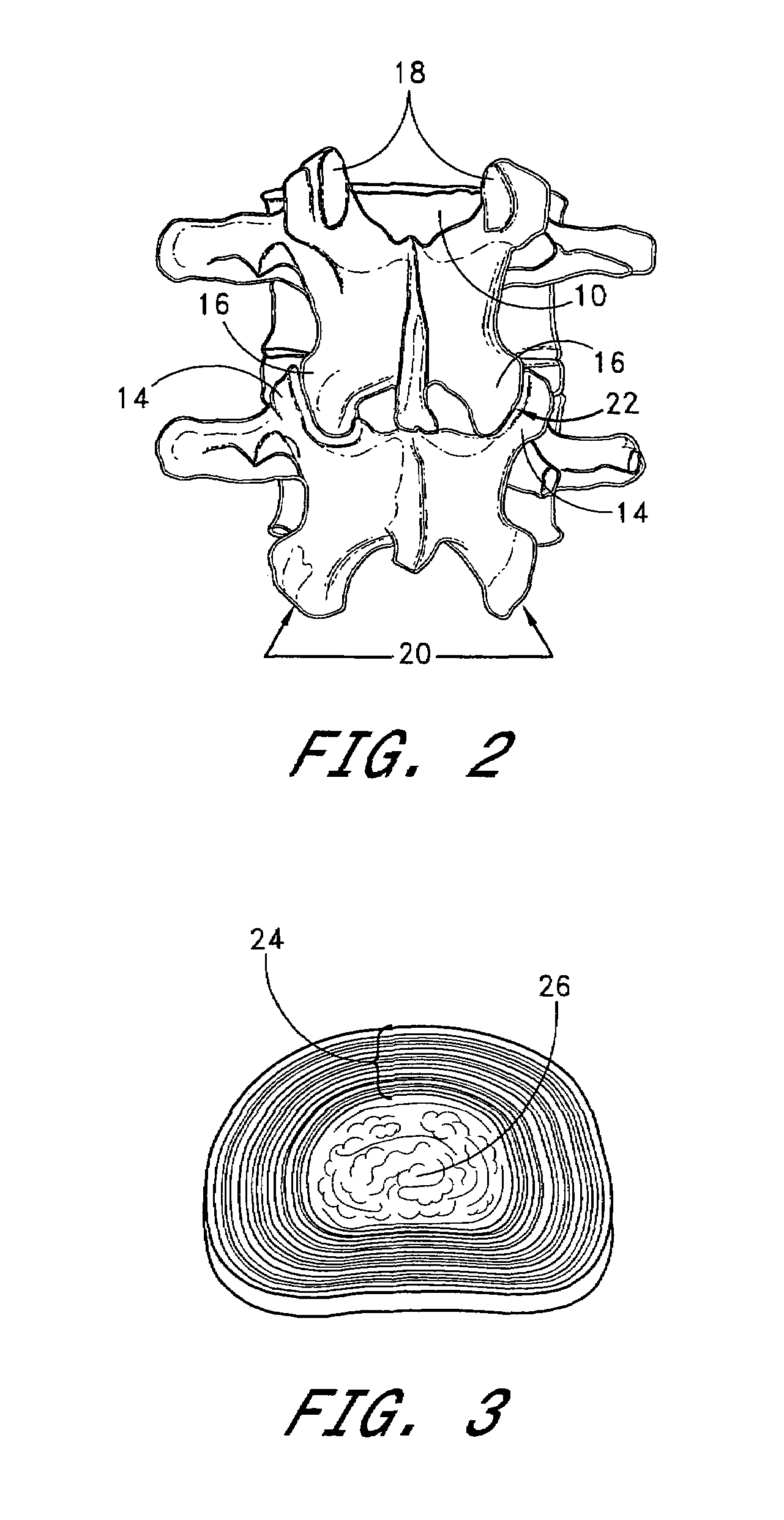 Method of spinal fixation using adhesive media