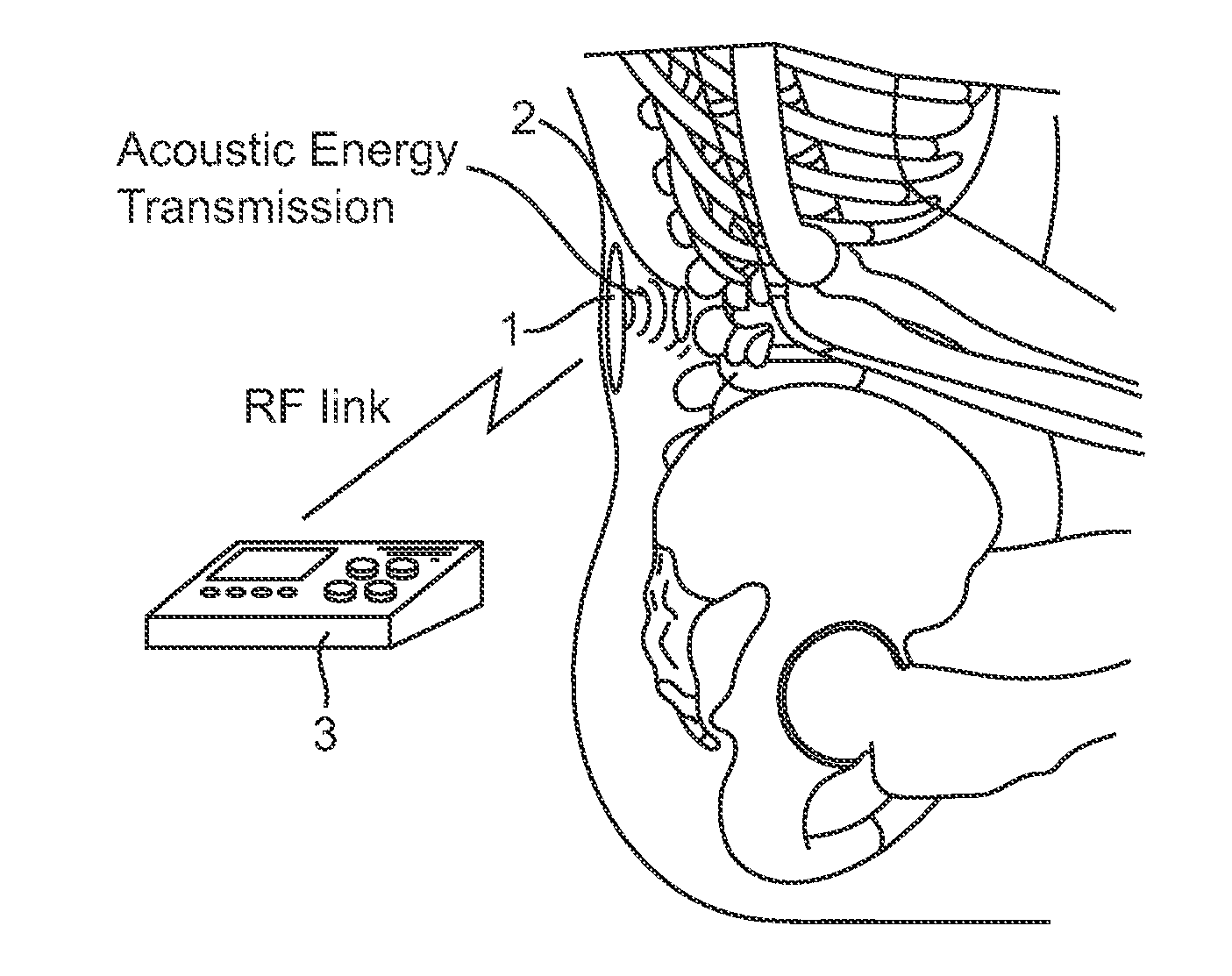 Systems and methods for implantable leadless spine stimulation