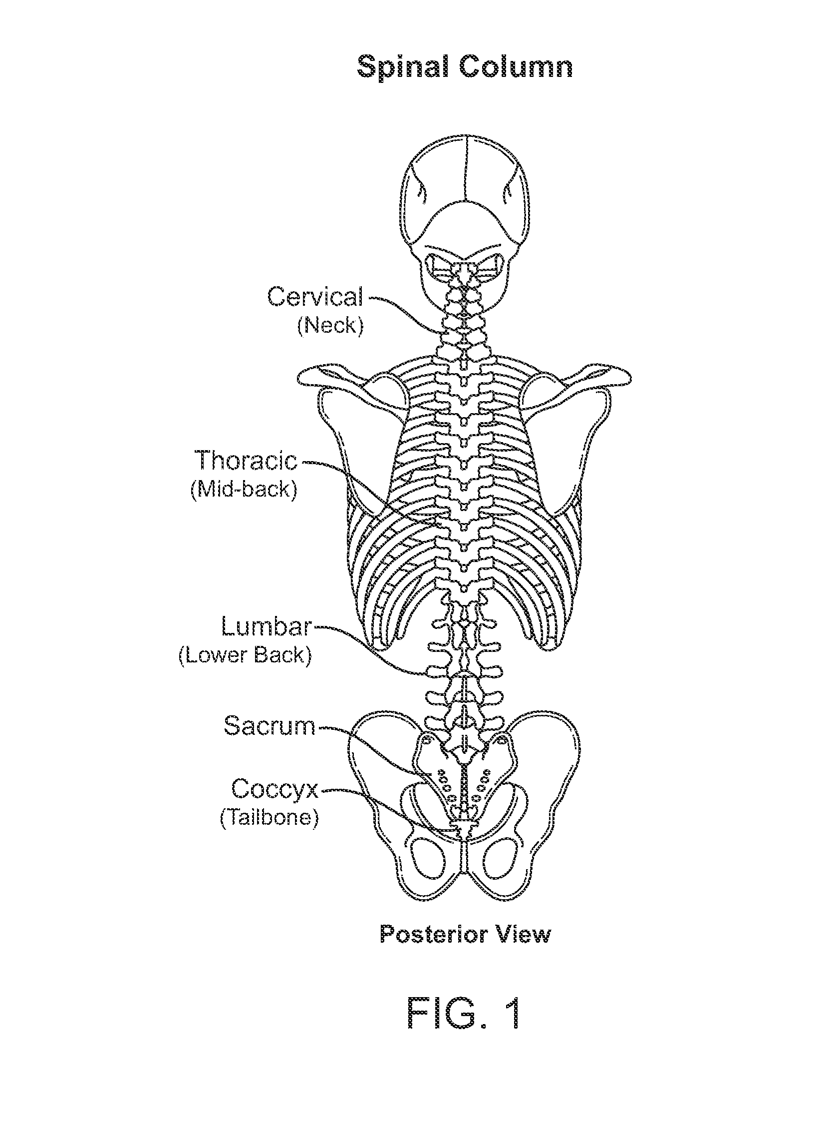 Systems and methods for implantable leadless spine stimulation