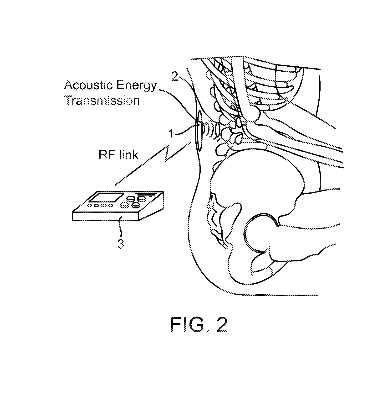 Systems and methods for implantable leadless spine stimulation