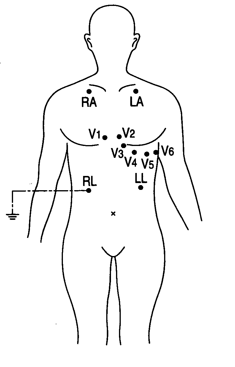 Method for deriving standard 12-lead electrocardiogram, and electrocardiograph using the same