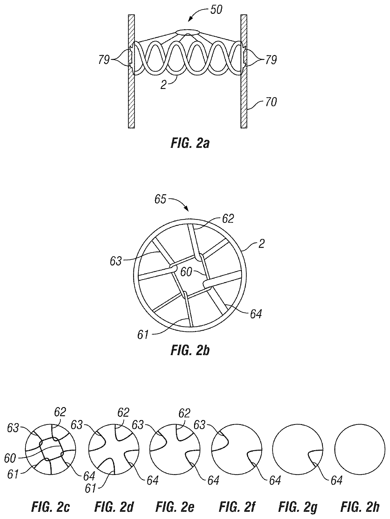 Absorbable vascular filter