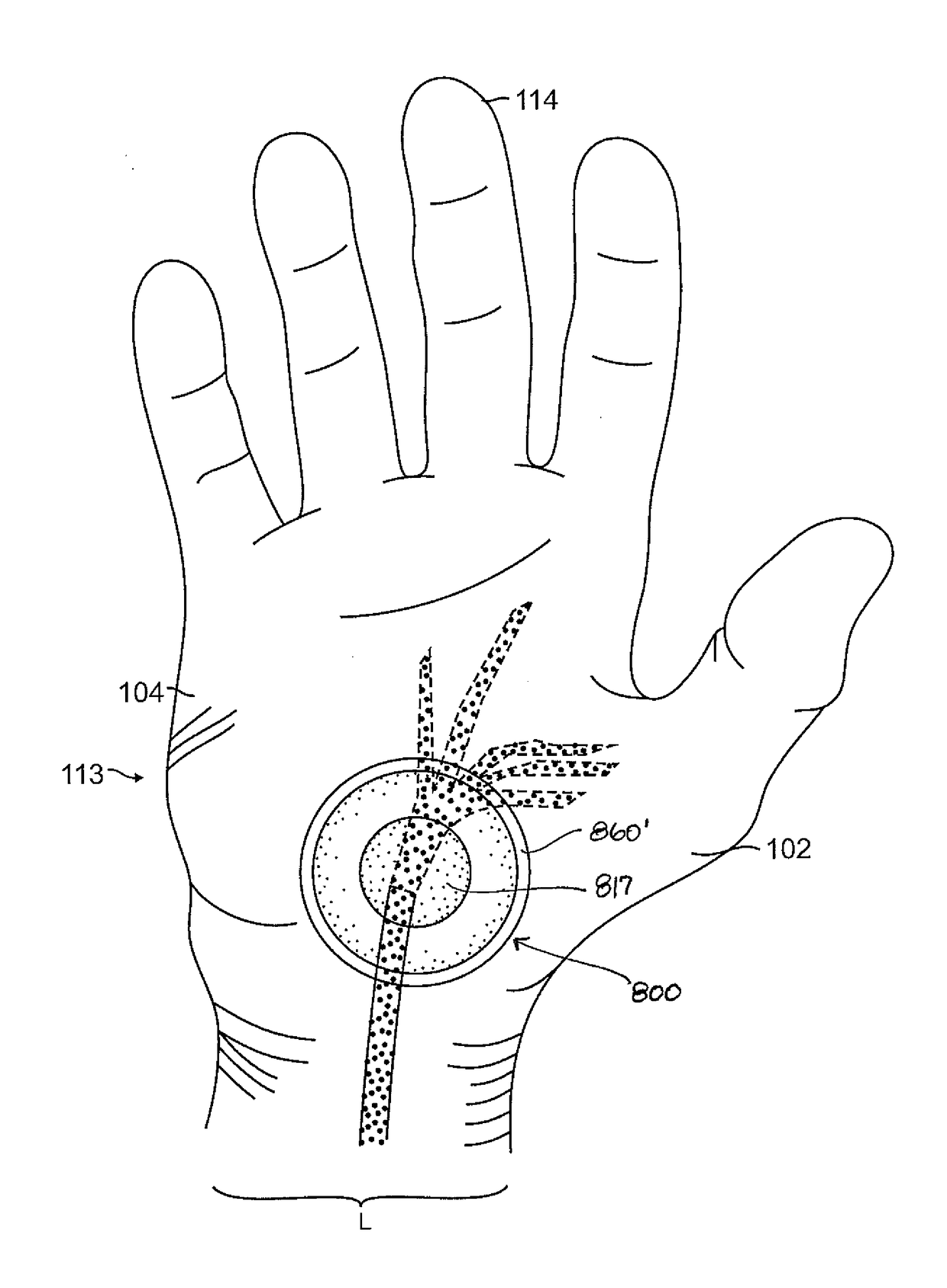 Therapeutic skin lifting device and related systems and methods