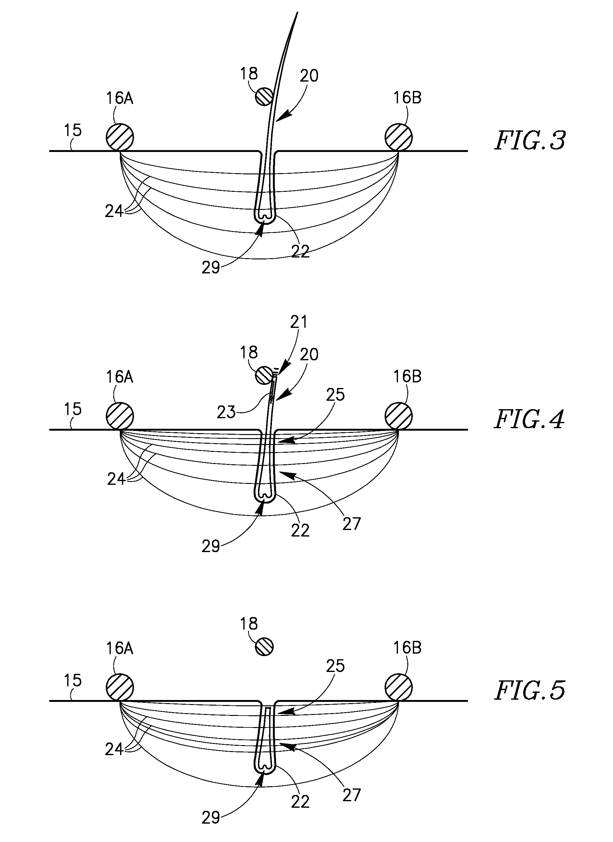 Methods, devices and systems for hair removal