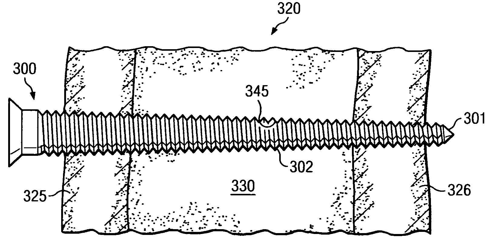 Engaging predetermined radial preloads in securing an orthopedic fastener