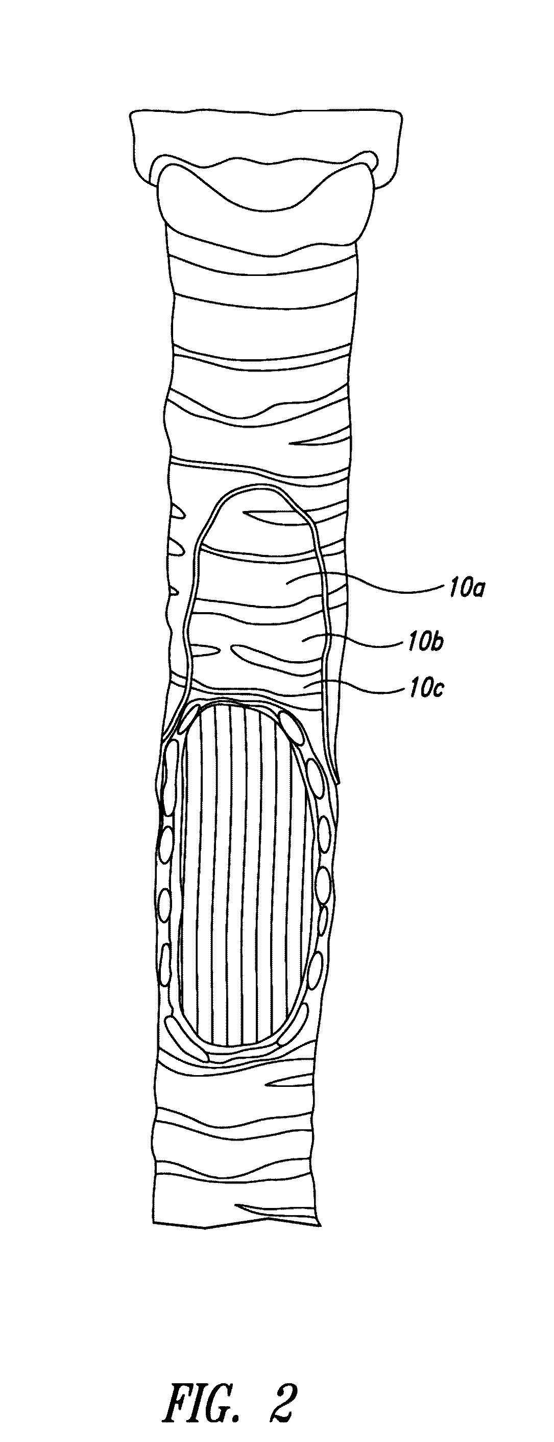 System and method for pulmonary treatment