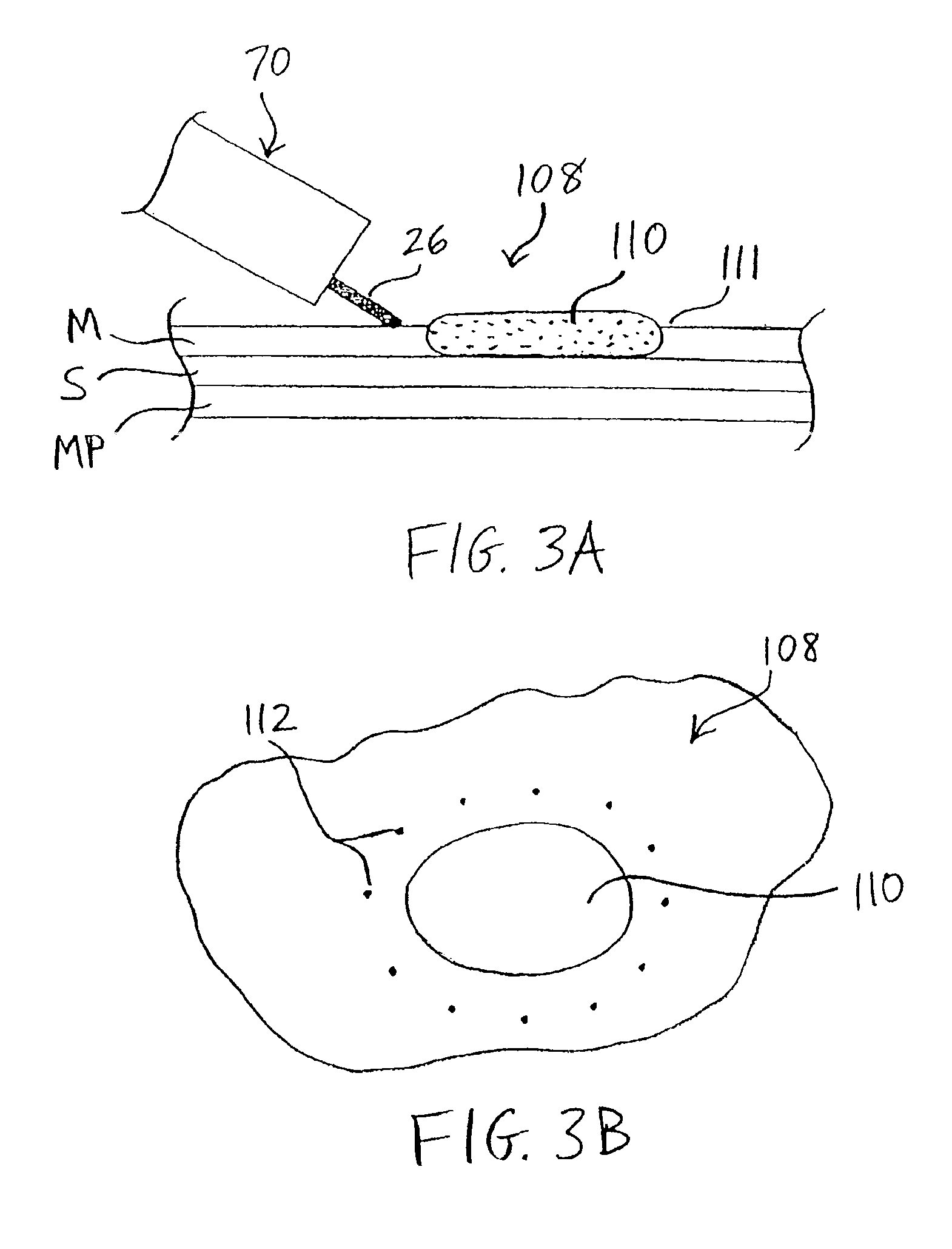 Apparatus and methods for endoscopic resection of tissue