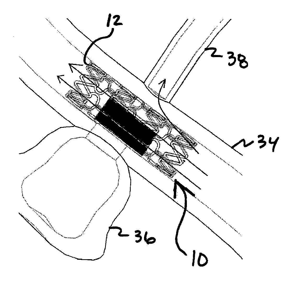 Aneurysm treatment system, device and method