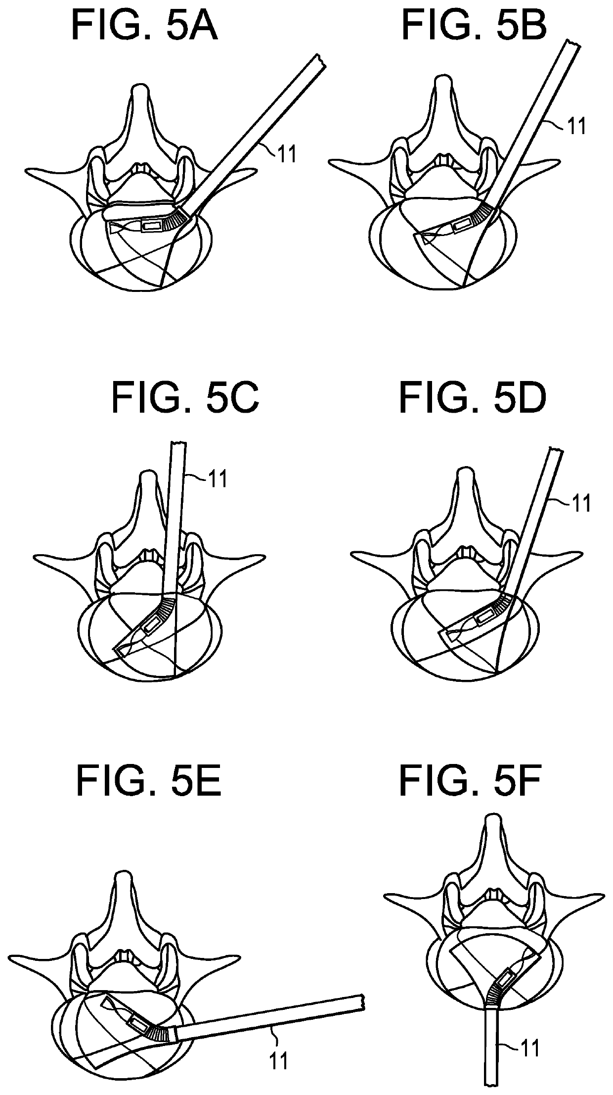 Percutaneous disc clearing device