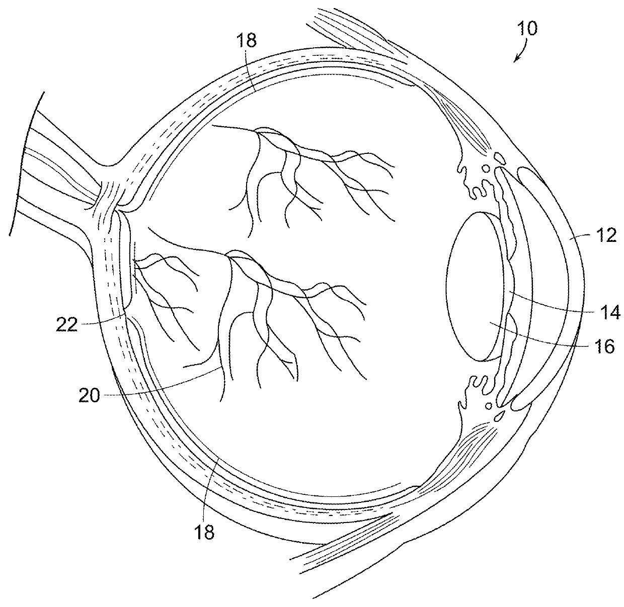 Subthreshold micropulse laser prophylactic treatment for chronic progressive retinal diseases