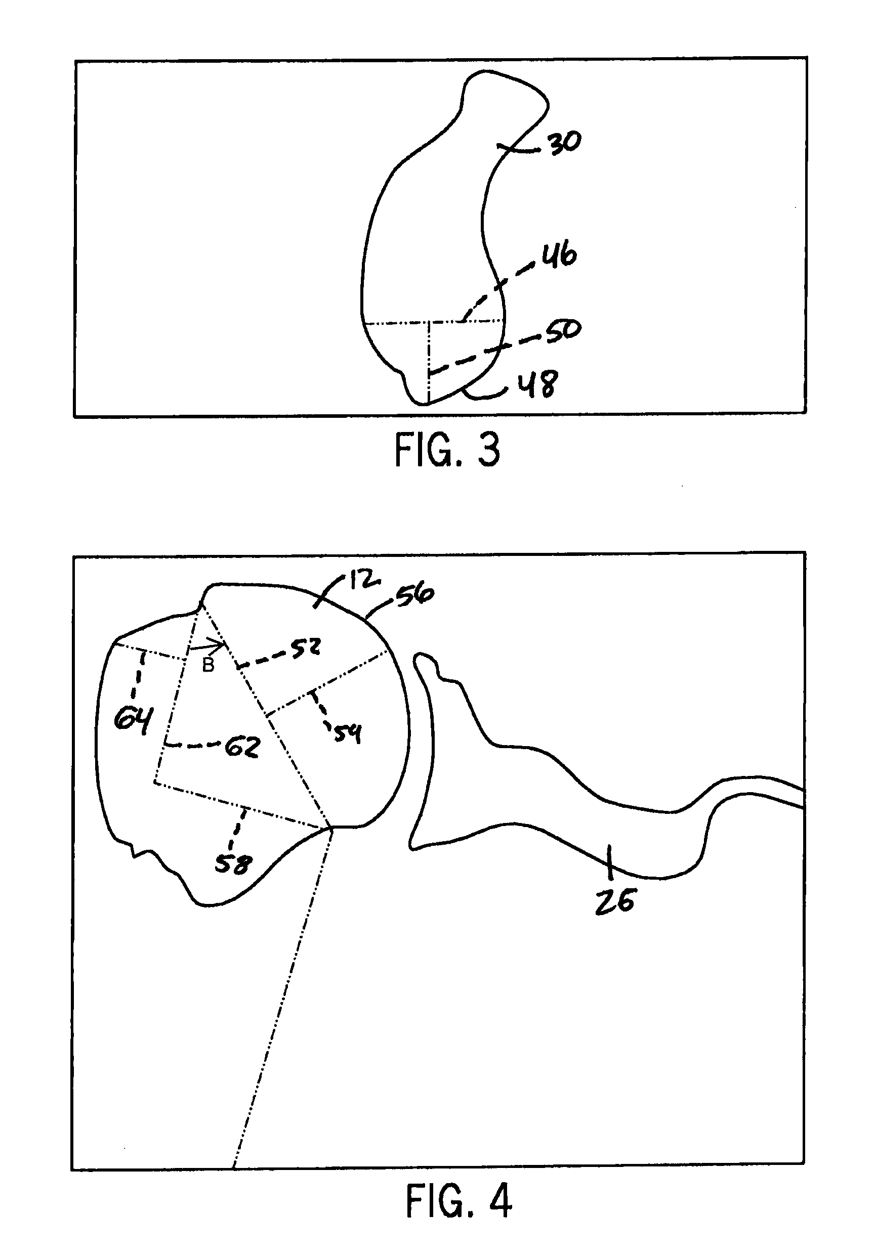 Method for optimization of joint arthroplasty component design